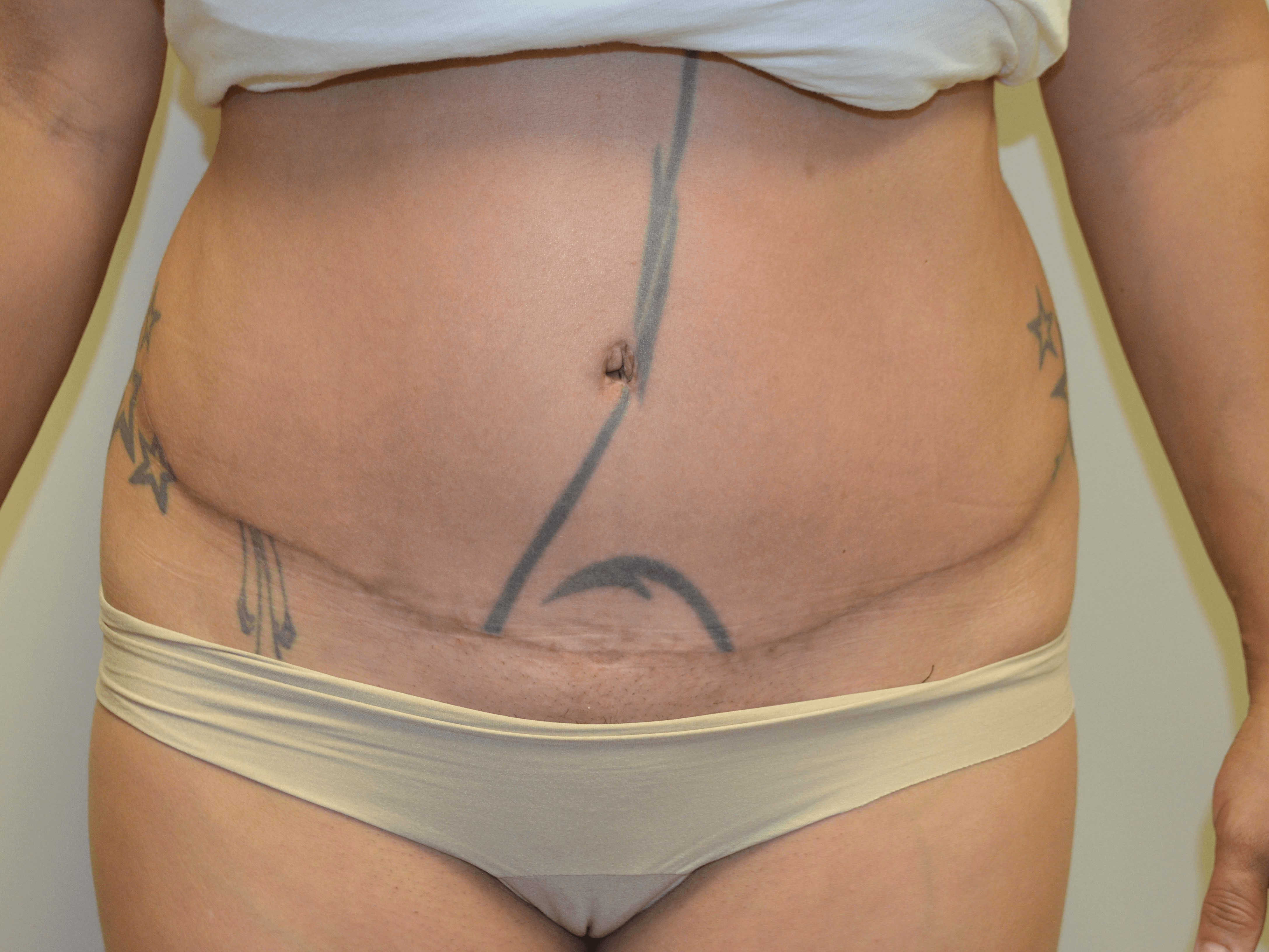 Tummy Tuck- Hinsdale, IL After