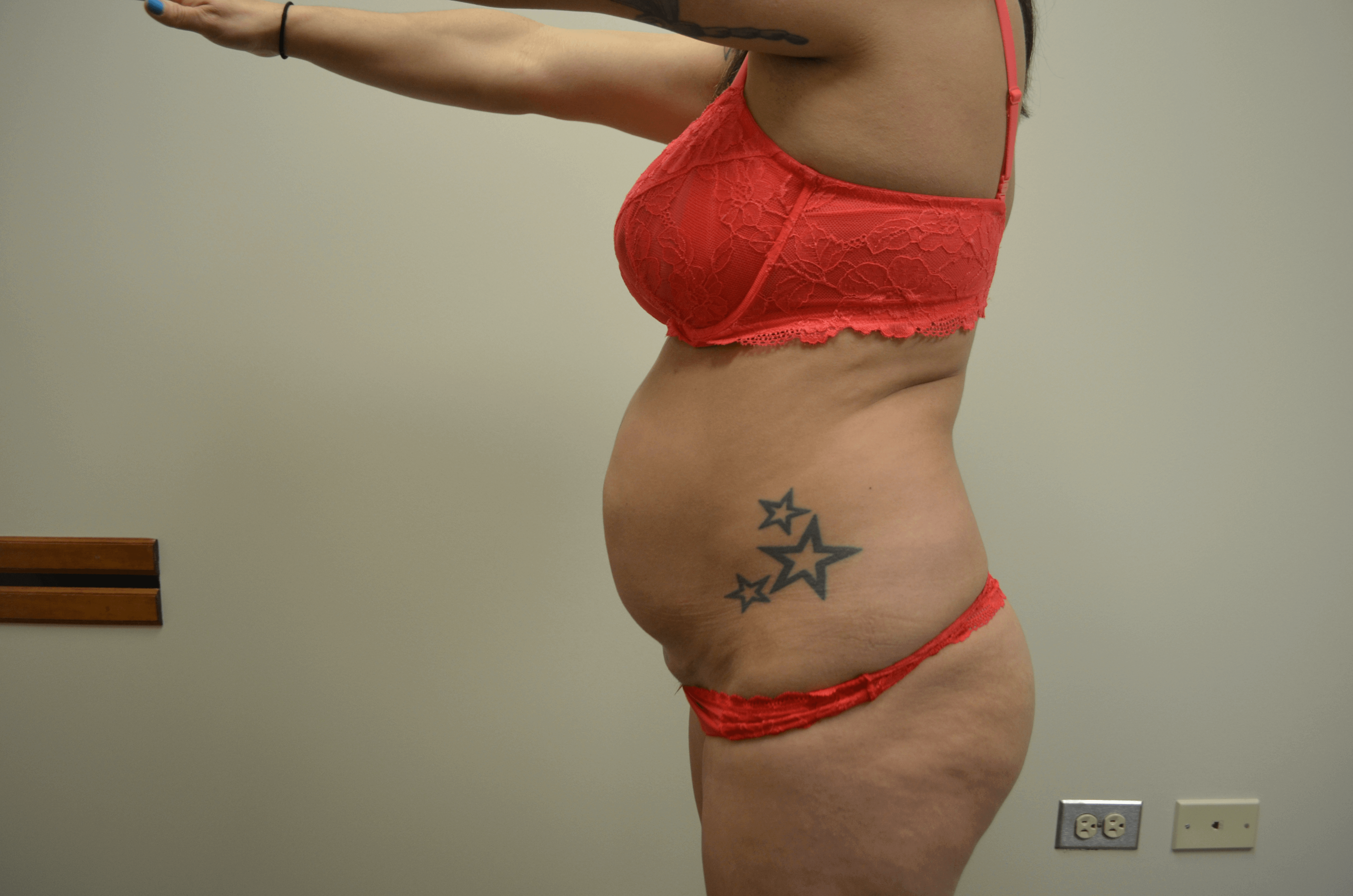 Tummy Tuck- Hinsdale, IL Before