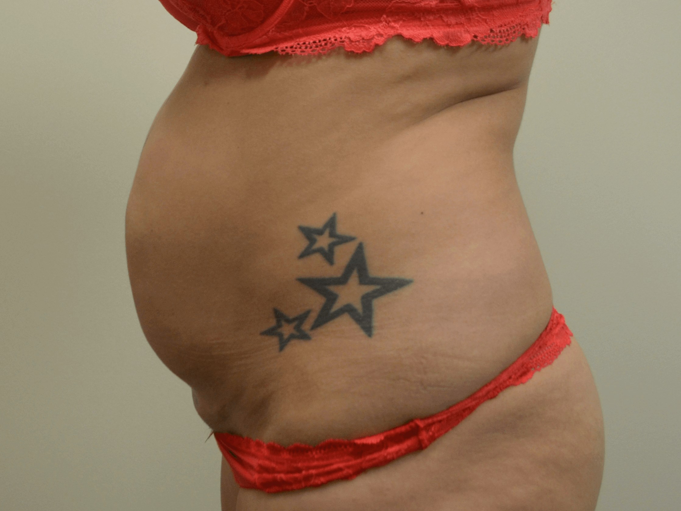 Tummy Tuck- Hinsdale, IL Before