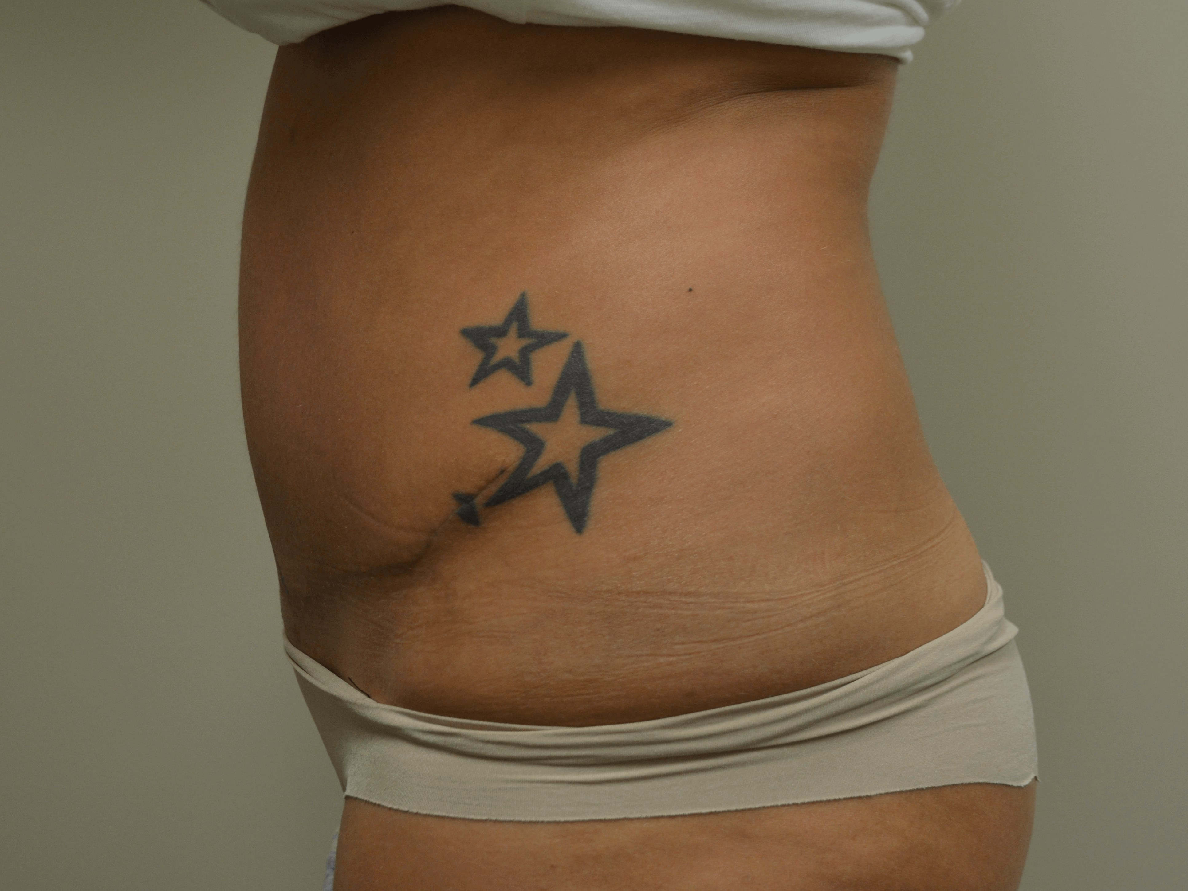 Tummy Tuck- Hinsdale, IL After