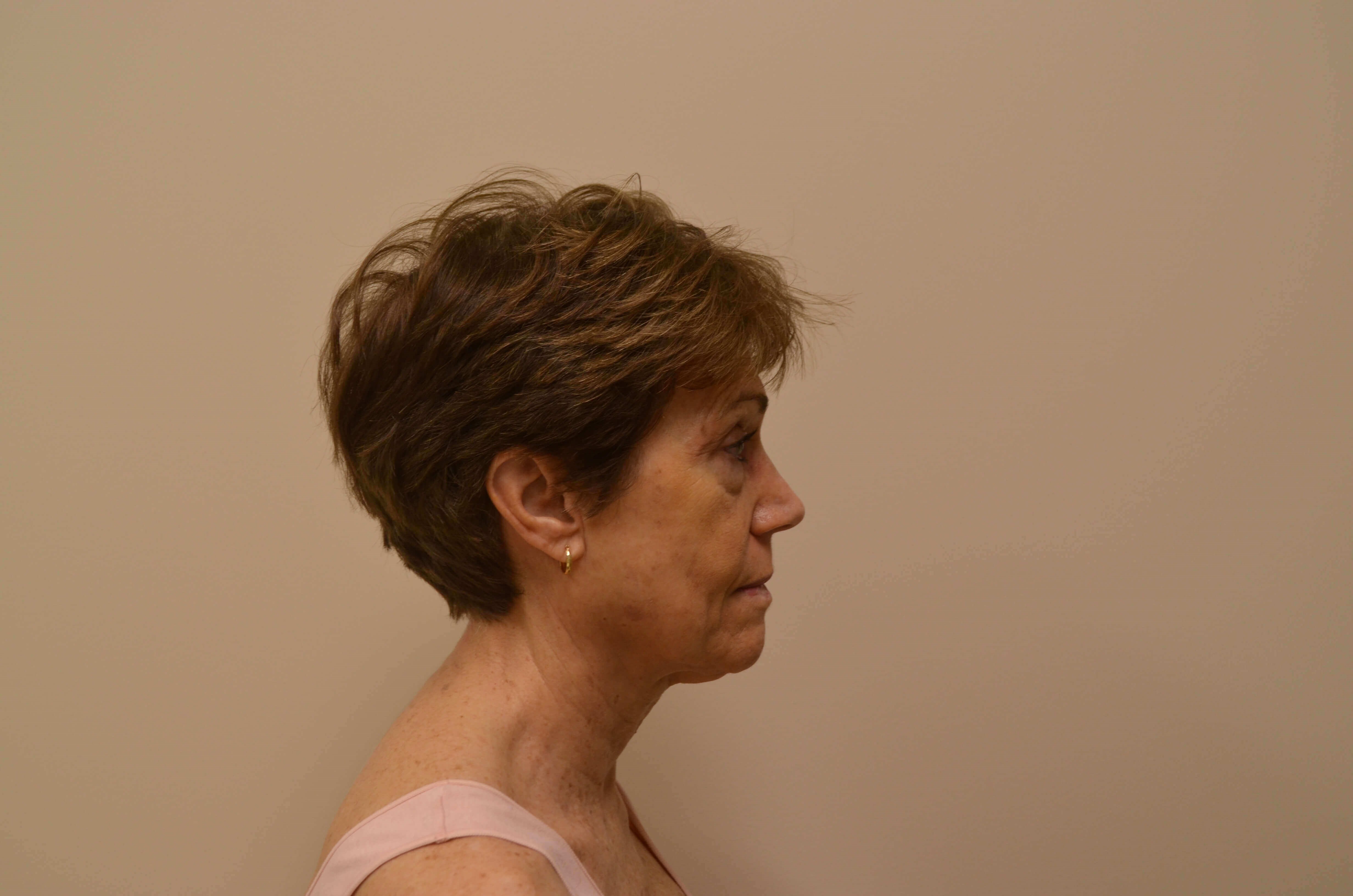 Lower Face & Neck Lift Before