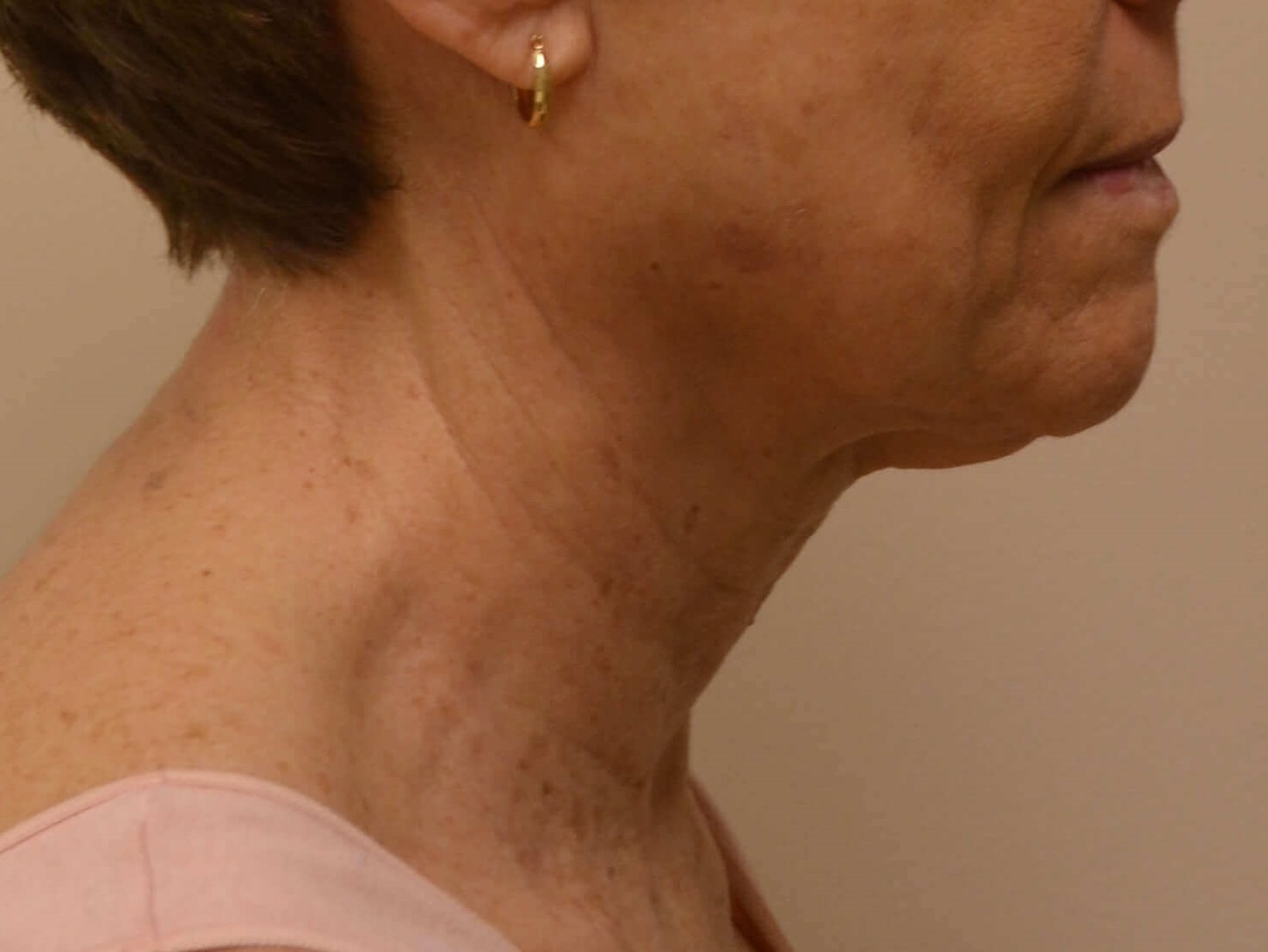 Lower Face & Neck Lift Before