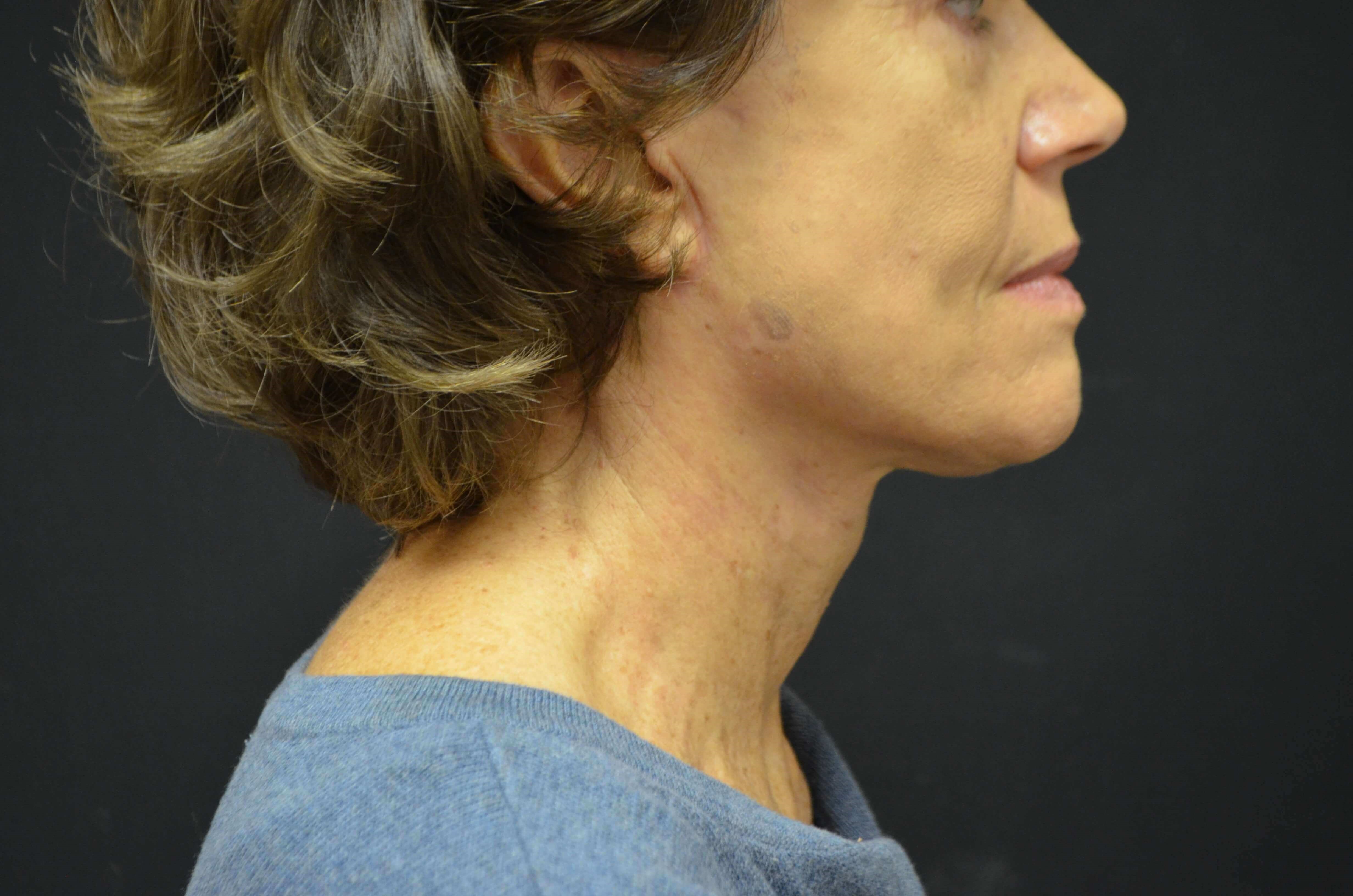 Lower Face & Neck Lift After