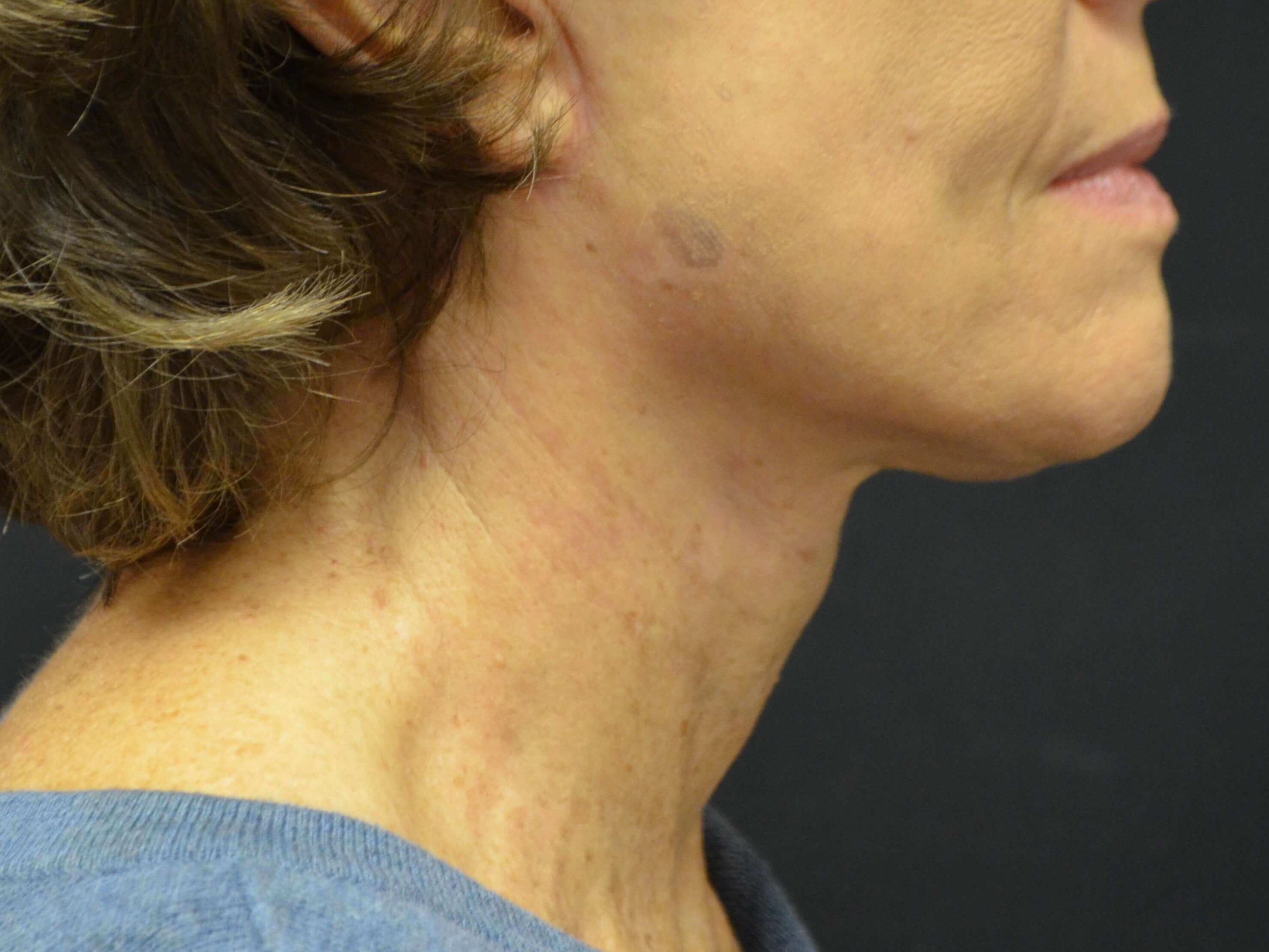 Lower Face & Neck Lift After