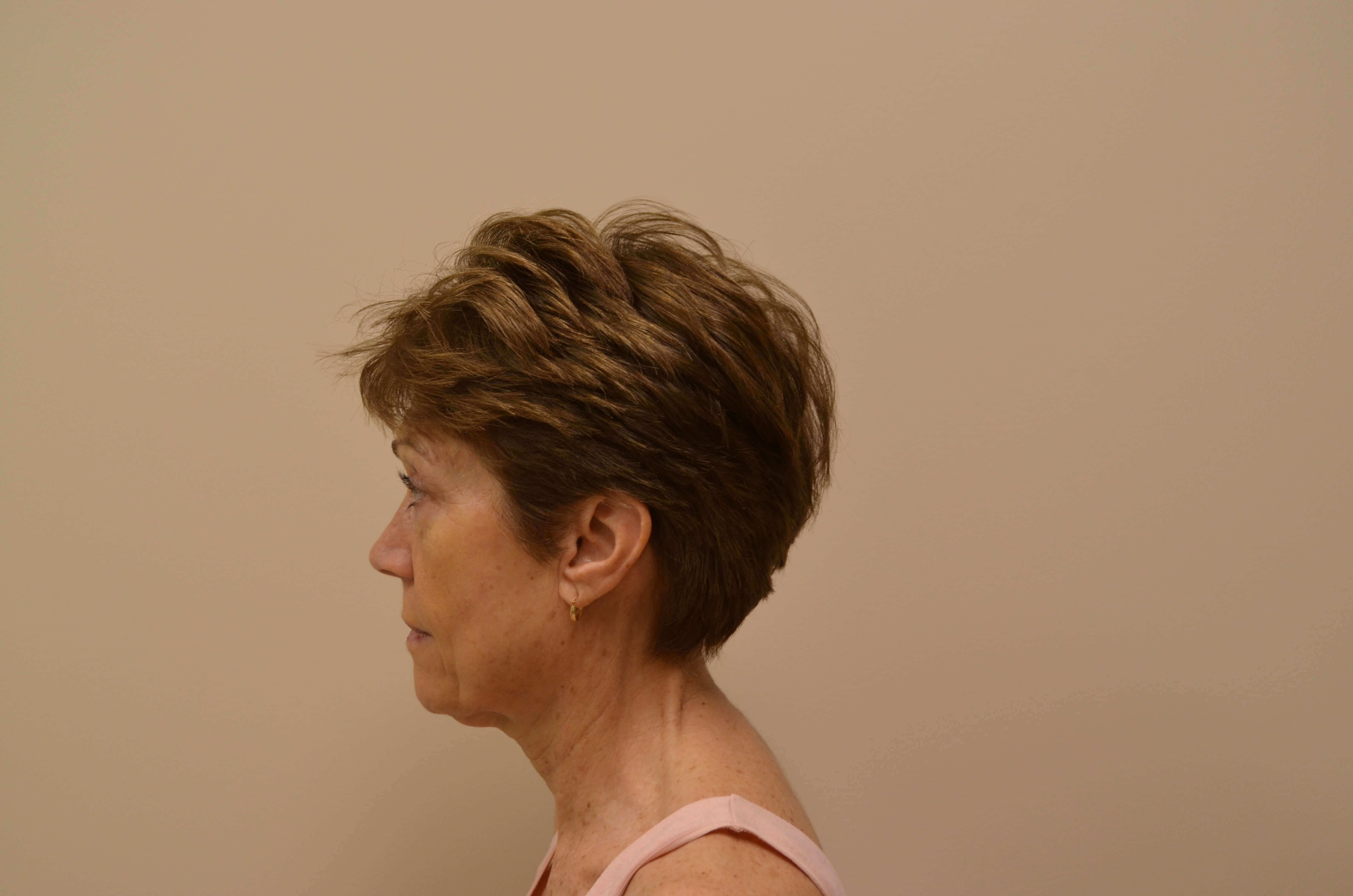 Lower Face & Neck Lift Before
