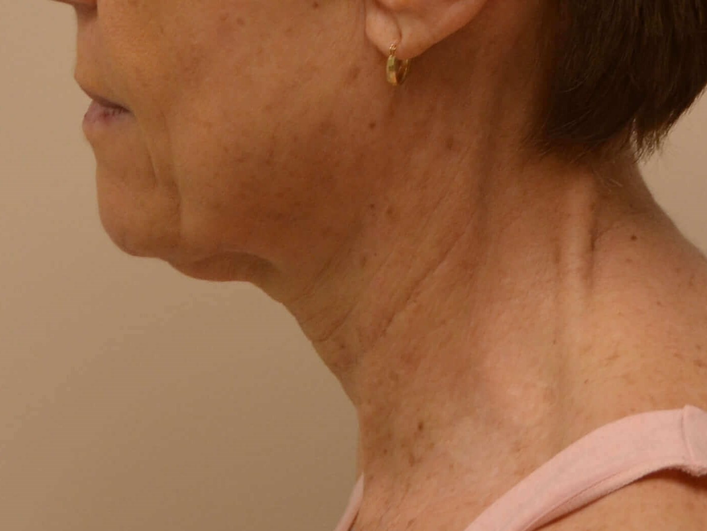 Lower Face & Neck Lift Before