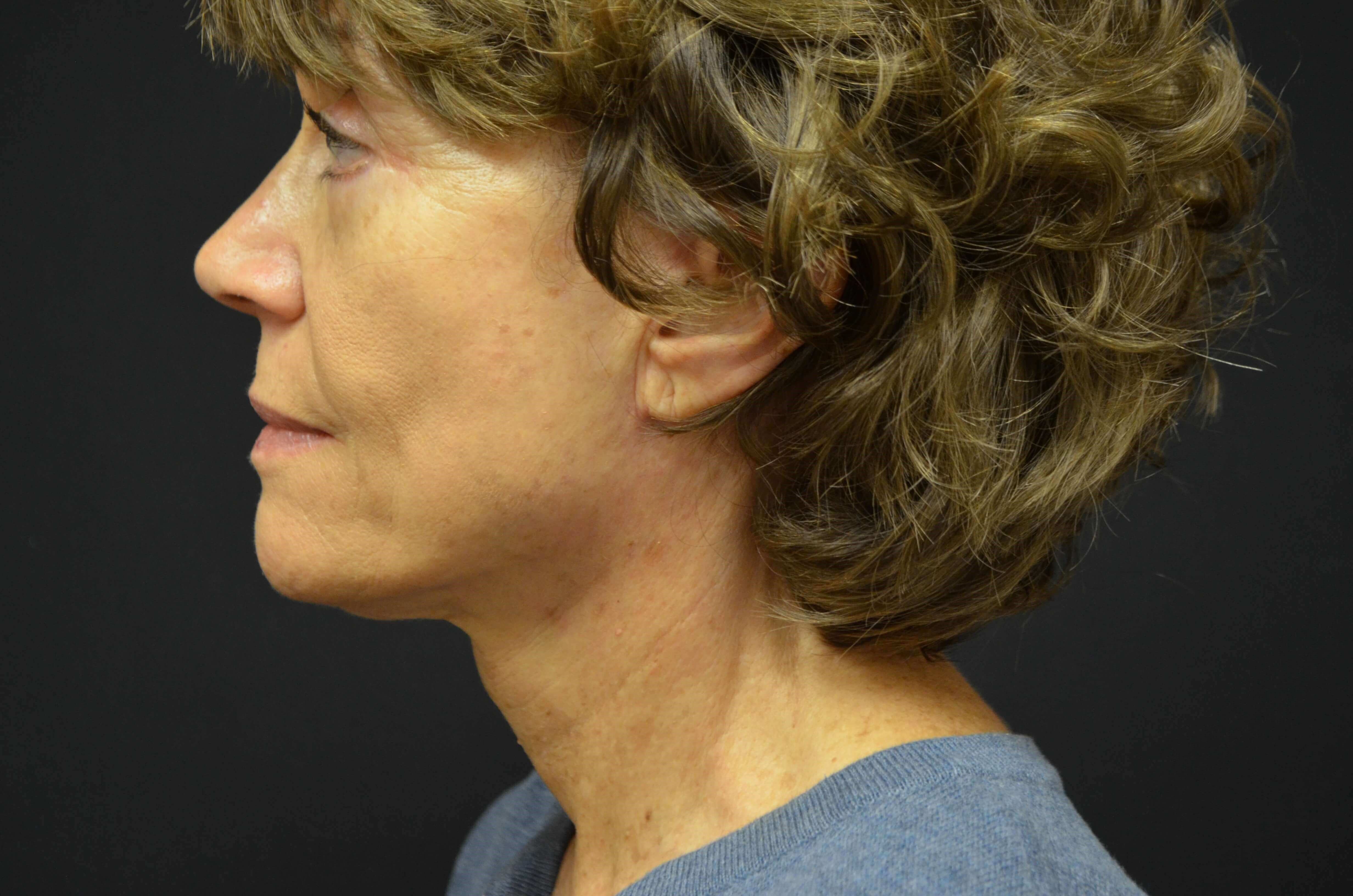 Lower Face & Neck Lift After
