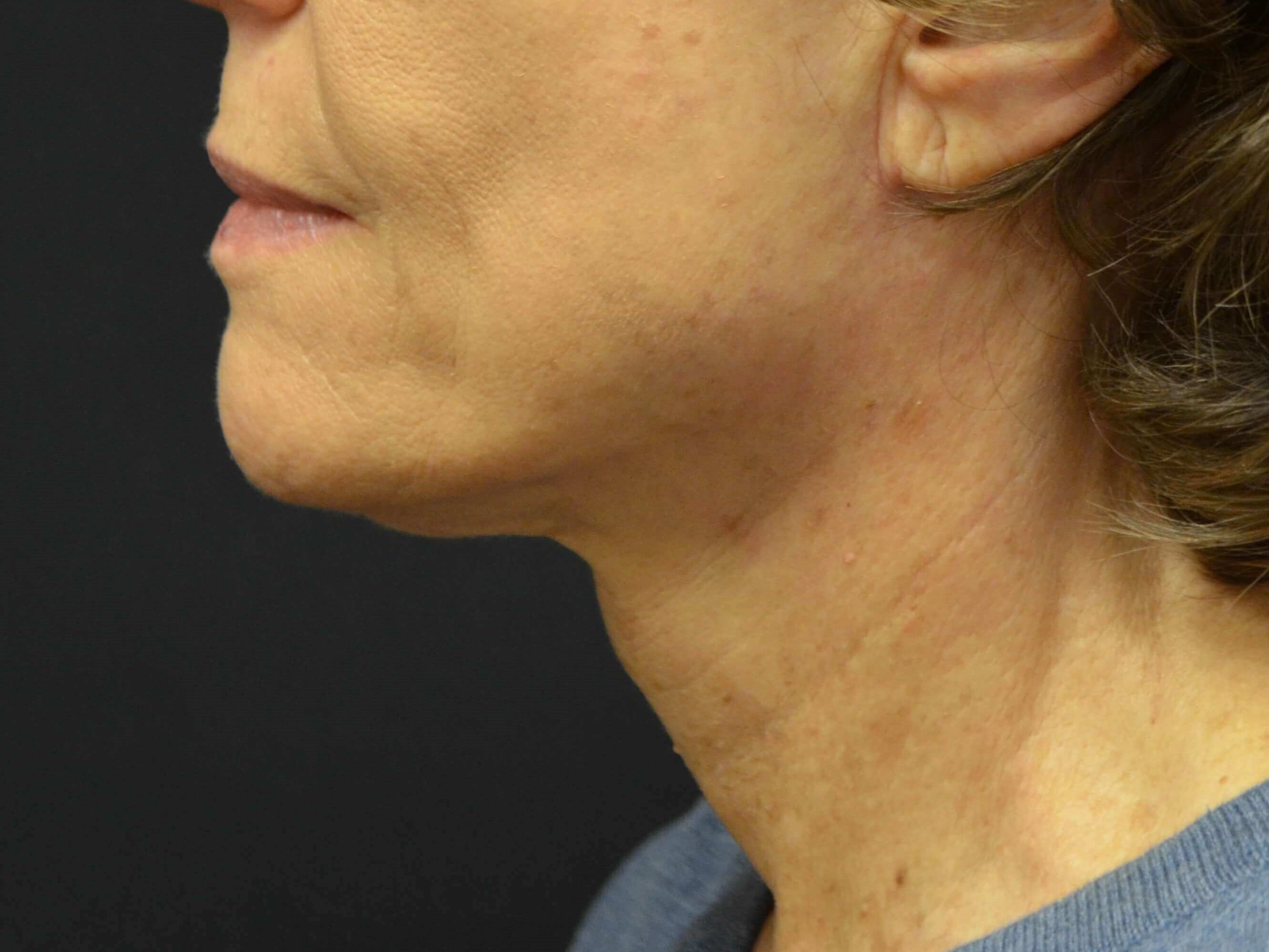 Lower Face & Neck Lift After