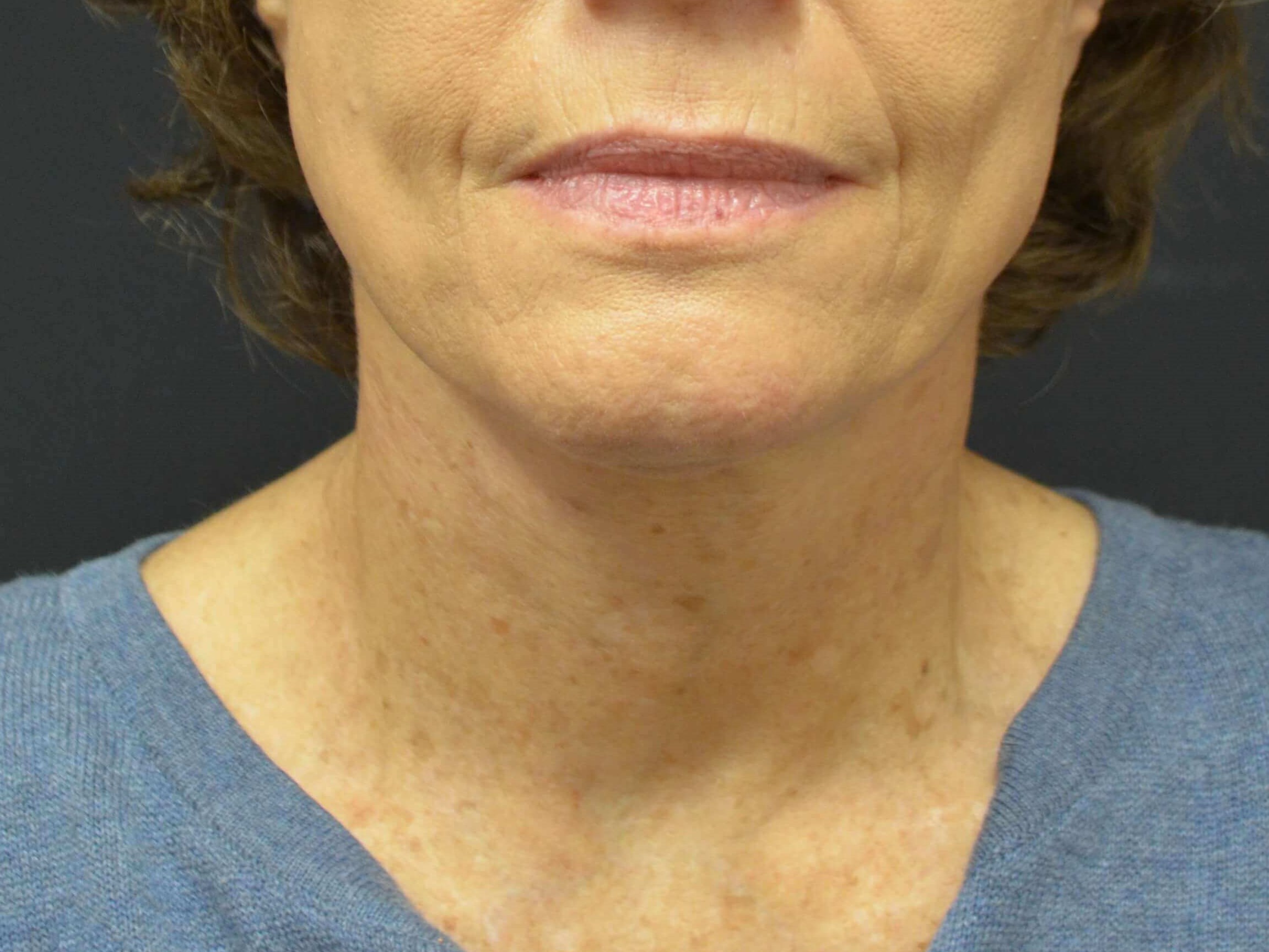 Lower Face & Neck Lift After