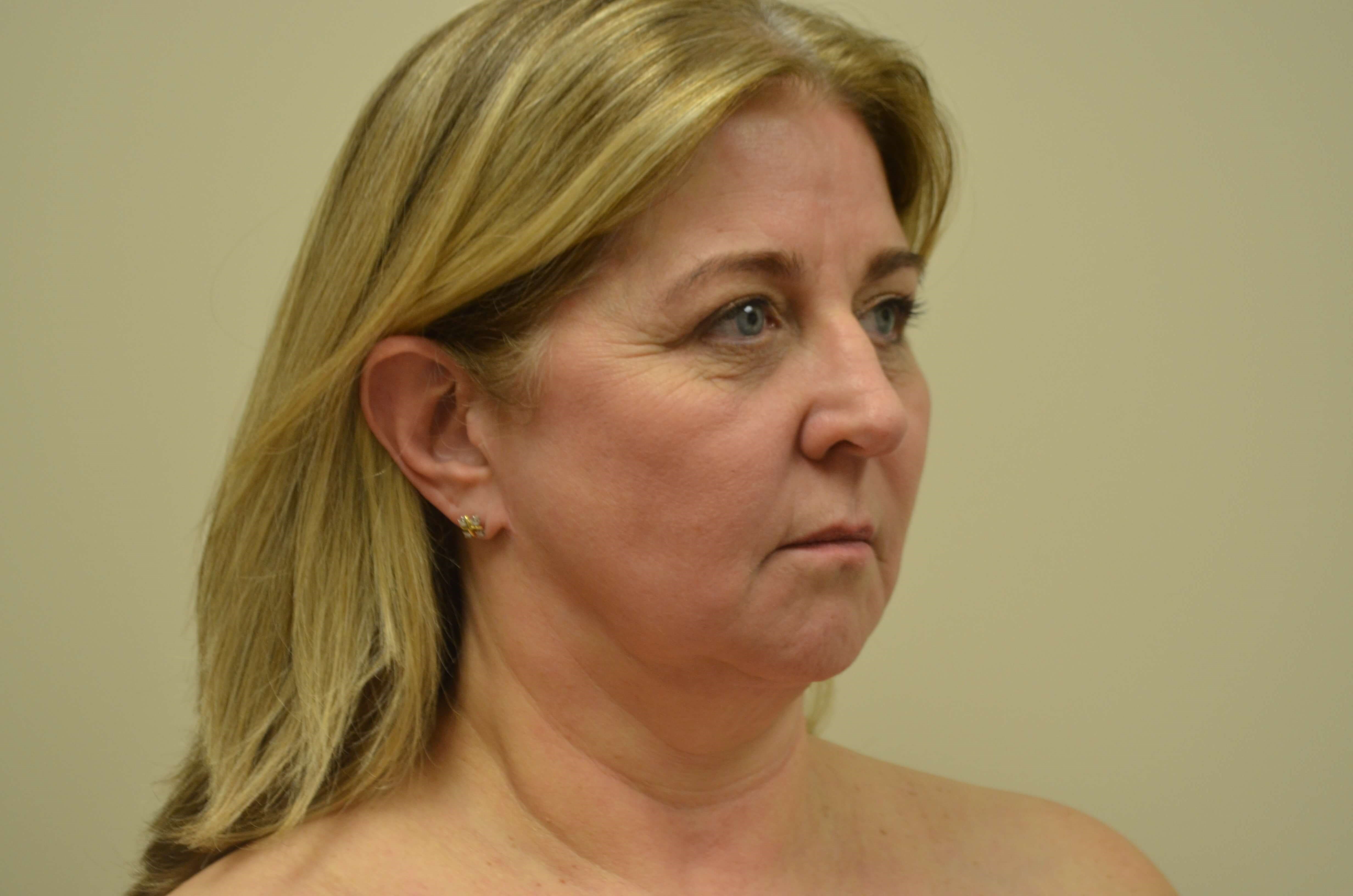 Lower Face & Neck Lift Before