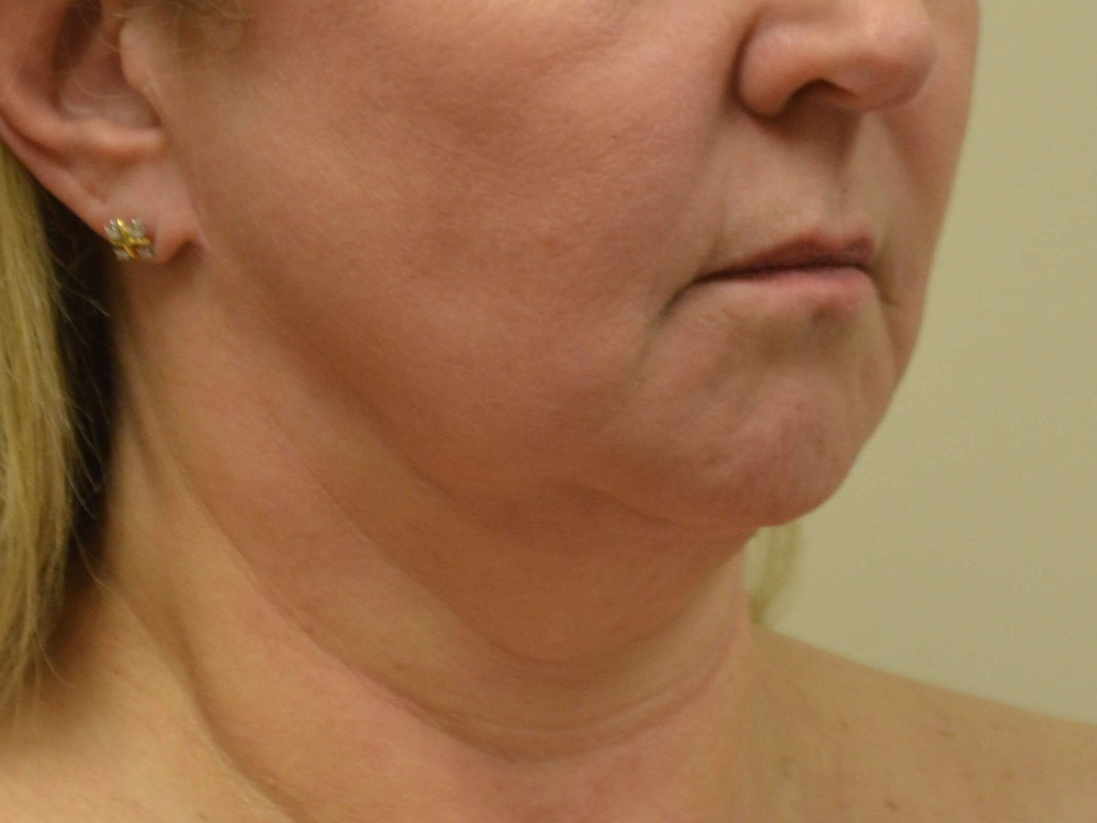 Lower Face & Neck Lift Before