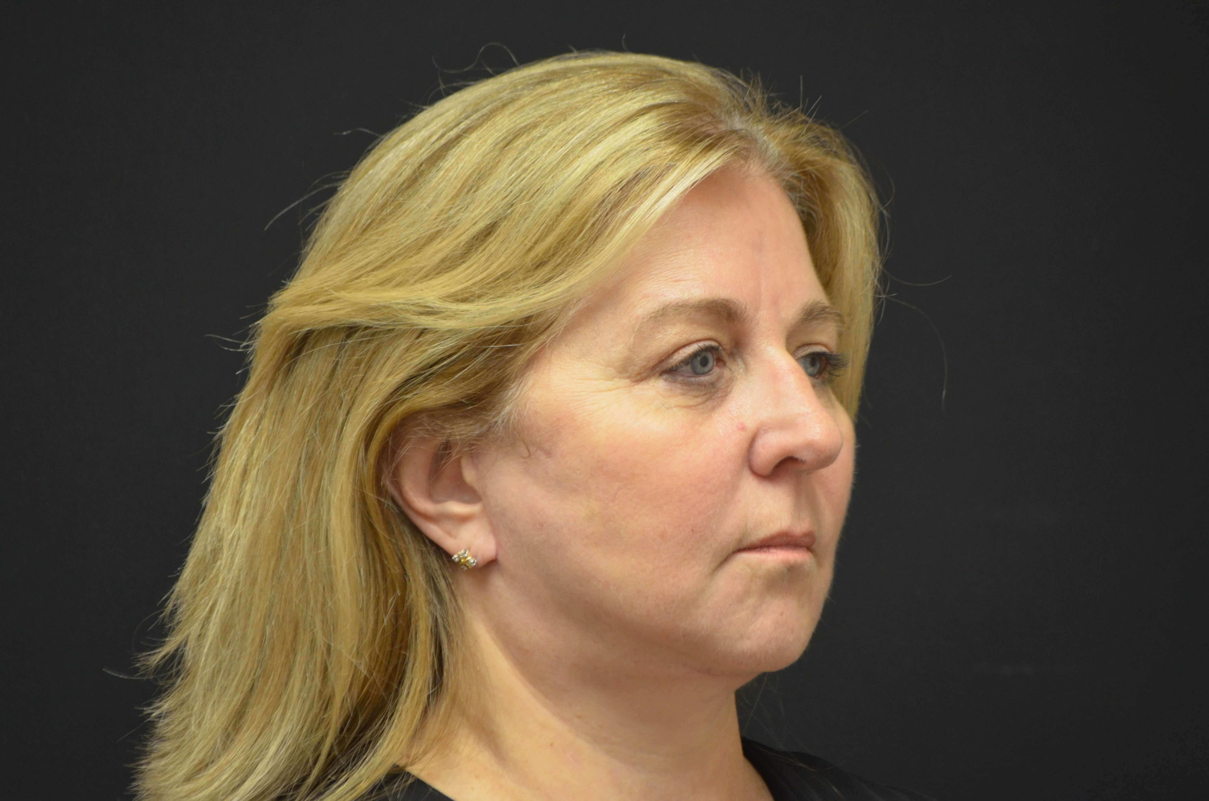 Lower Face & Neck Lift After