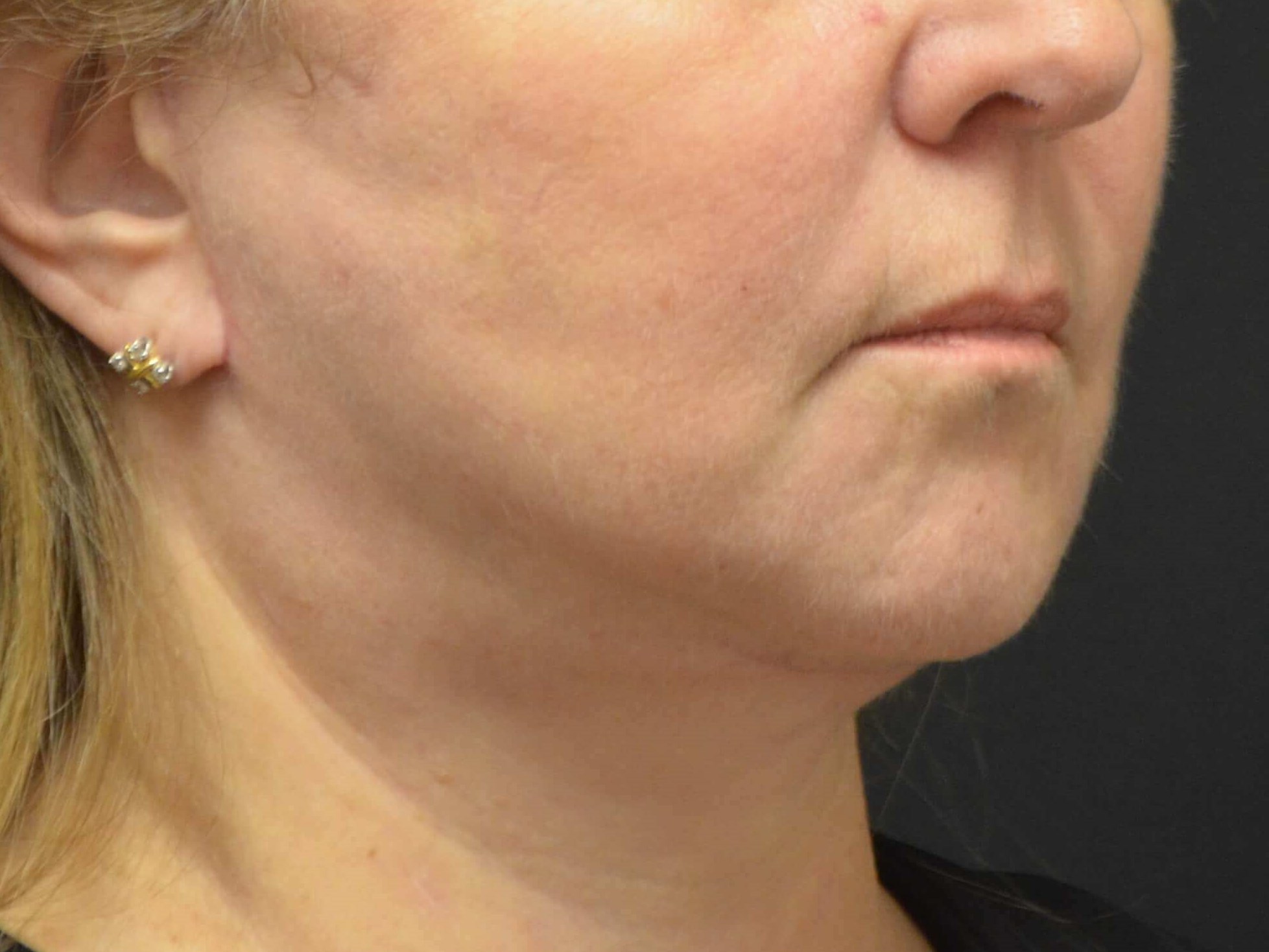 Lower Face & Neck Lift After