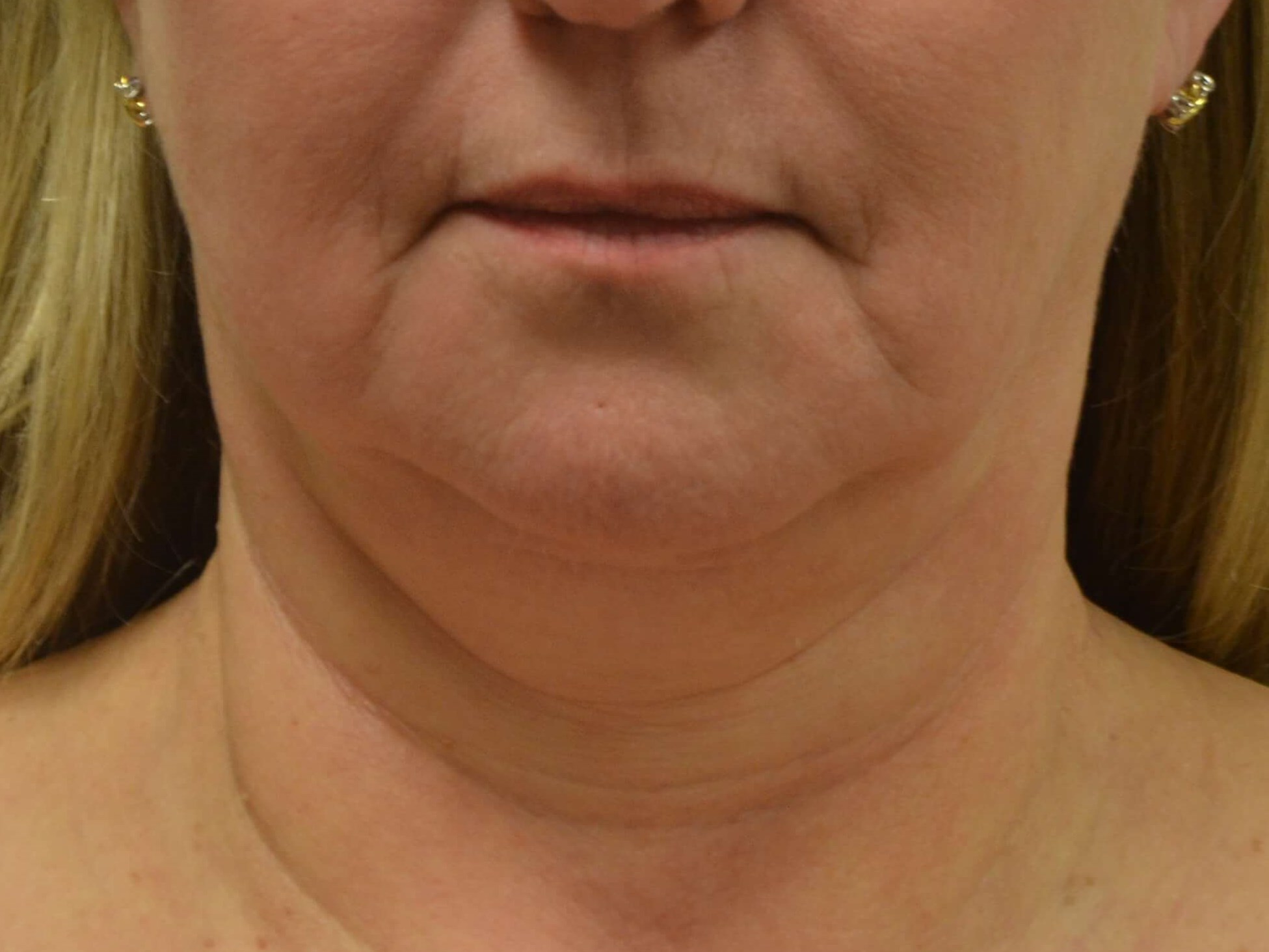Lower Face & Neck Lift Before