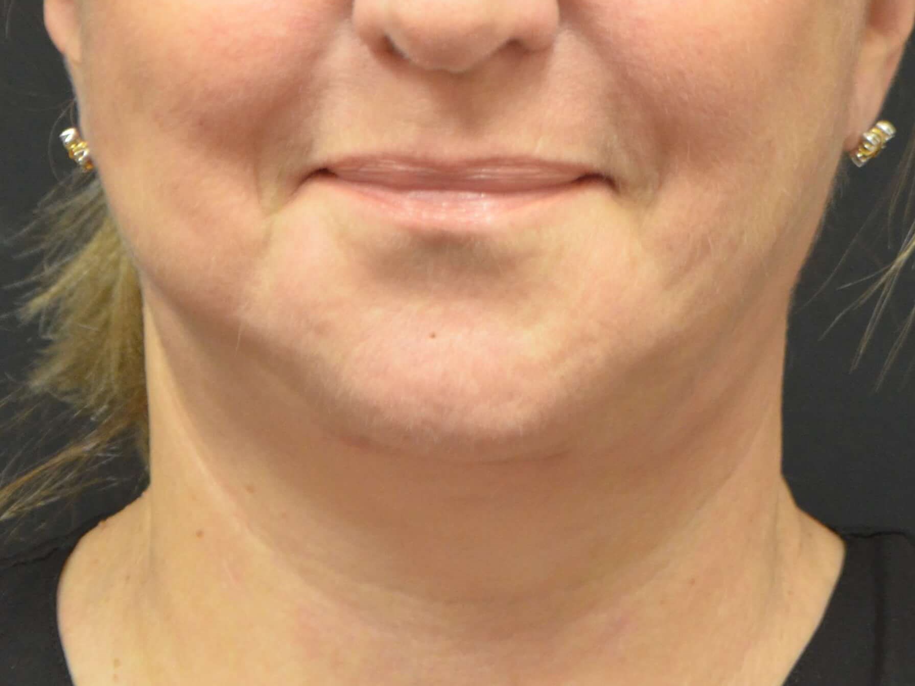 Lower Face & Neck Lift After