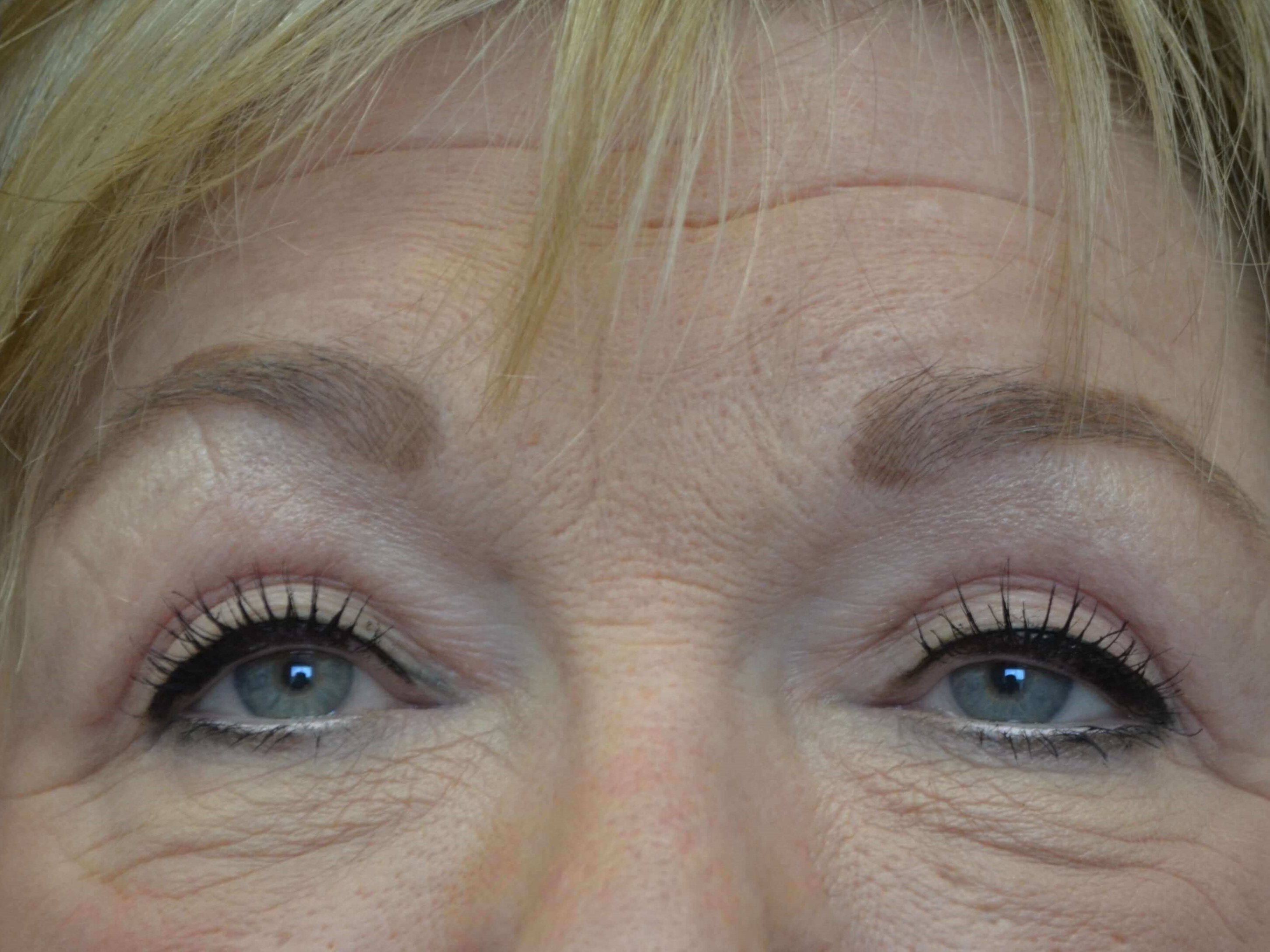 Upper Eyelid Lift After