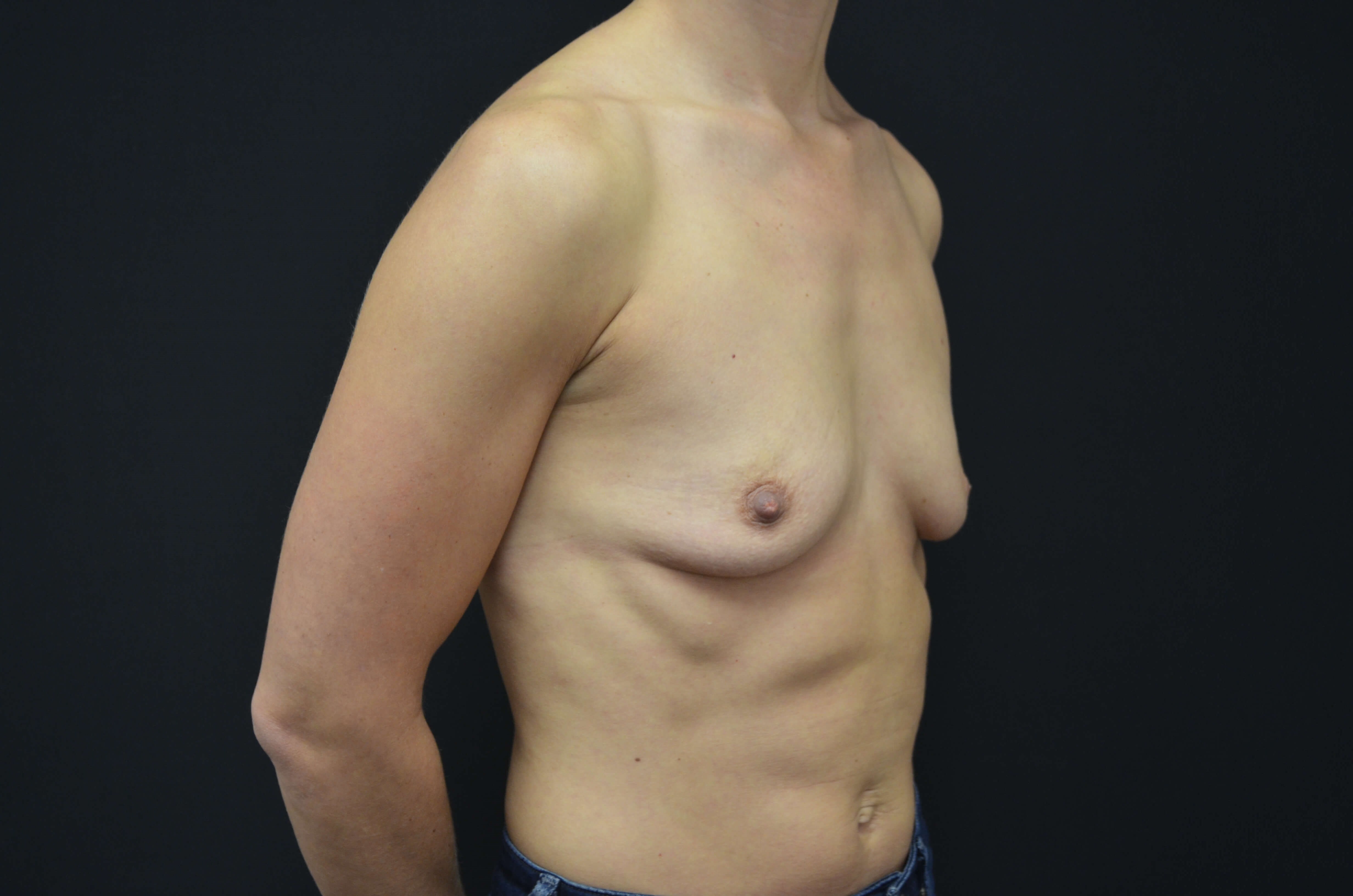 Breast Augmentation Before