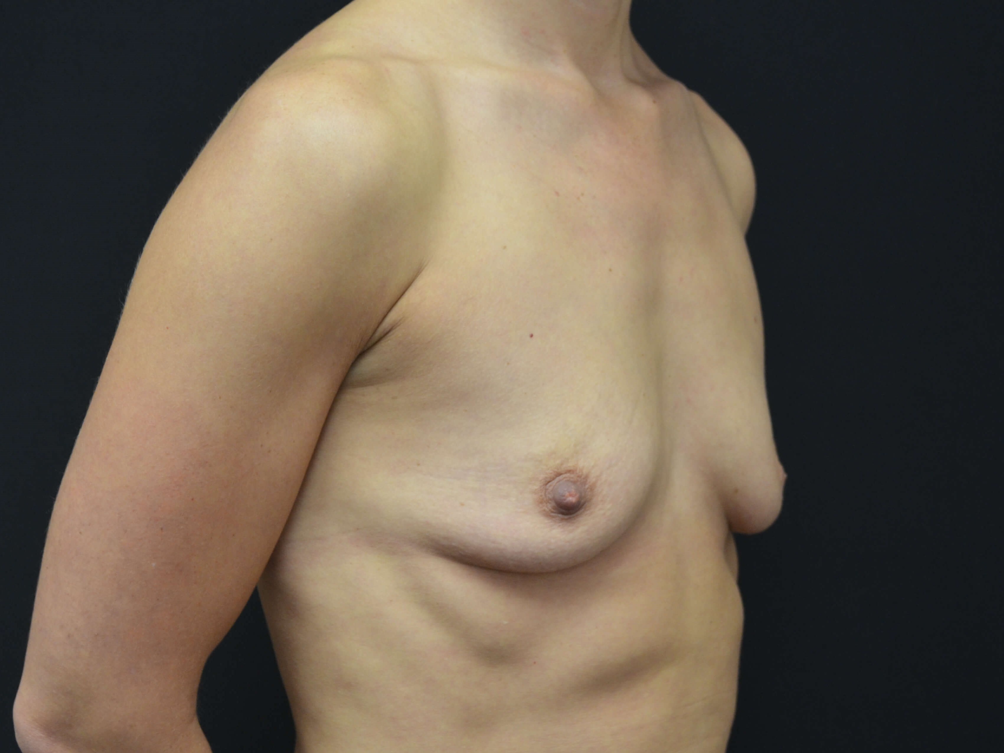 Breast Augmentation Before