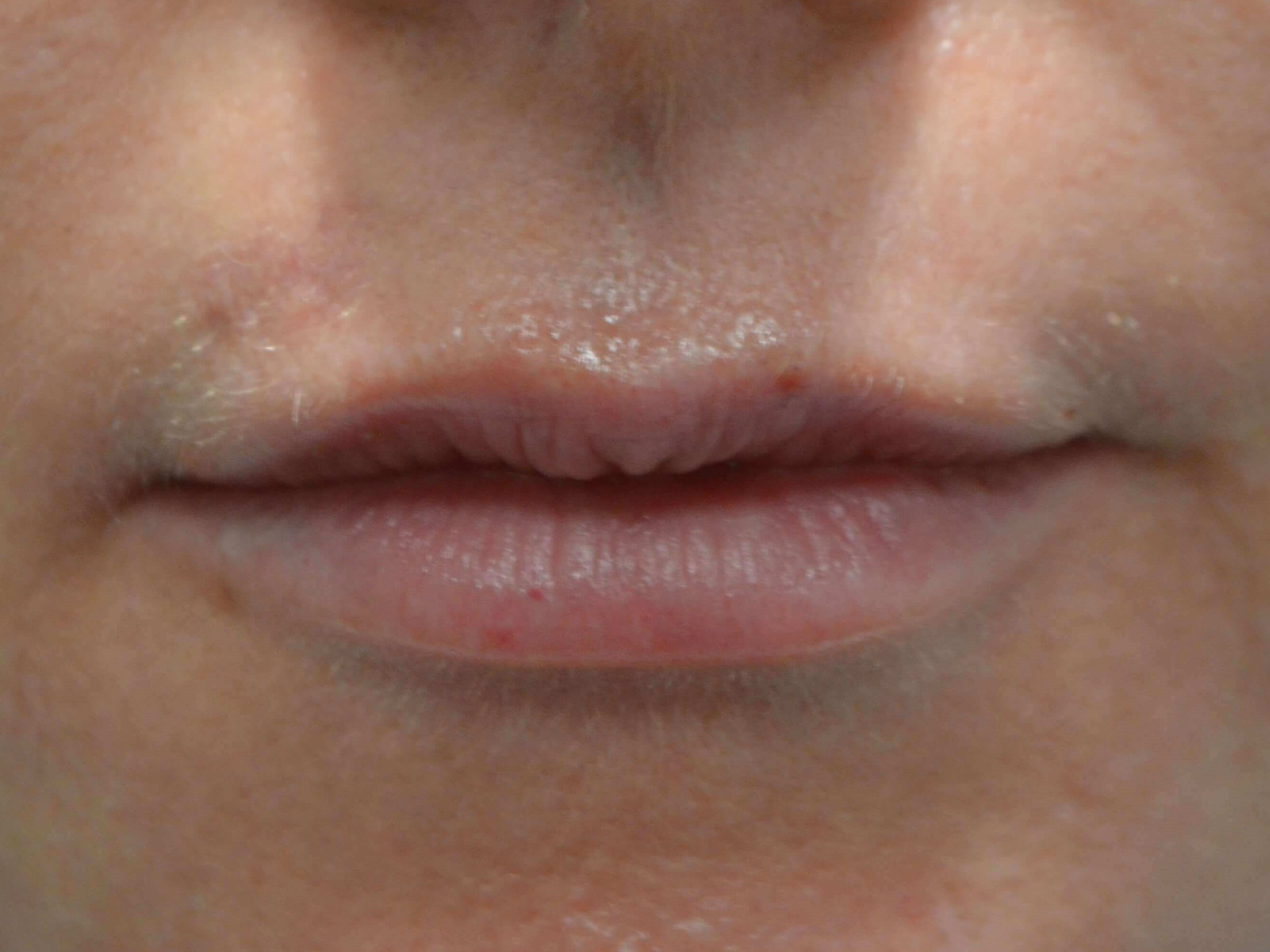 Lip Enhancement with Juvederm After