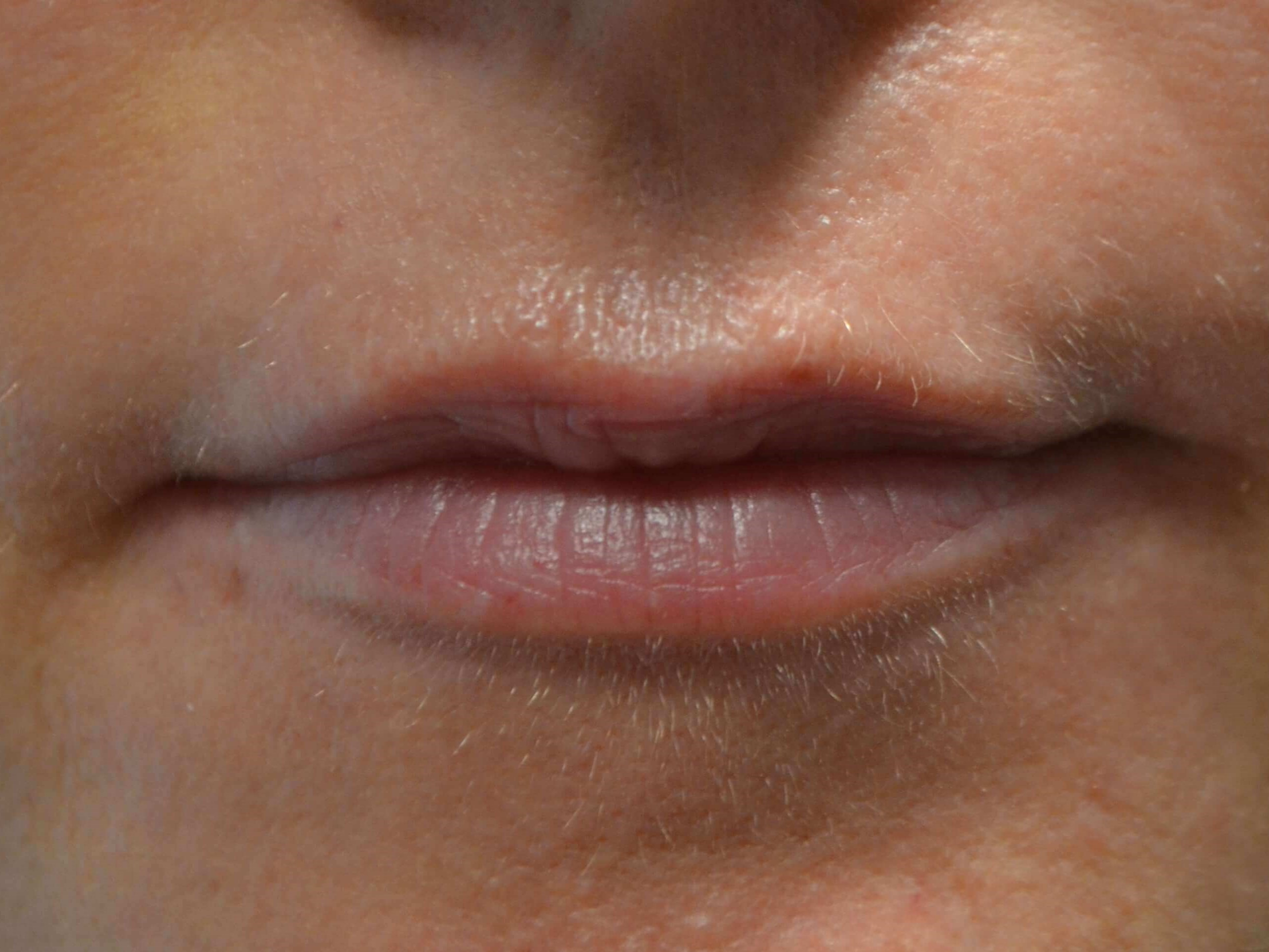 Lip Enhancement with Juvederm Before