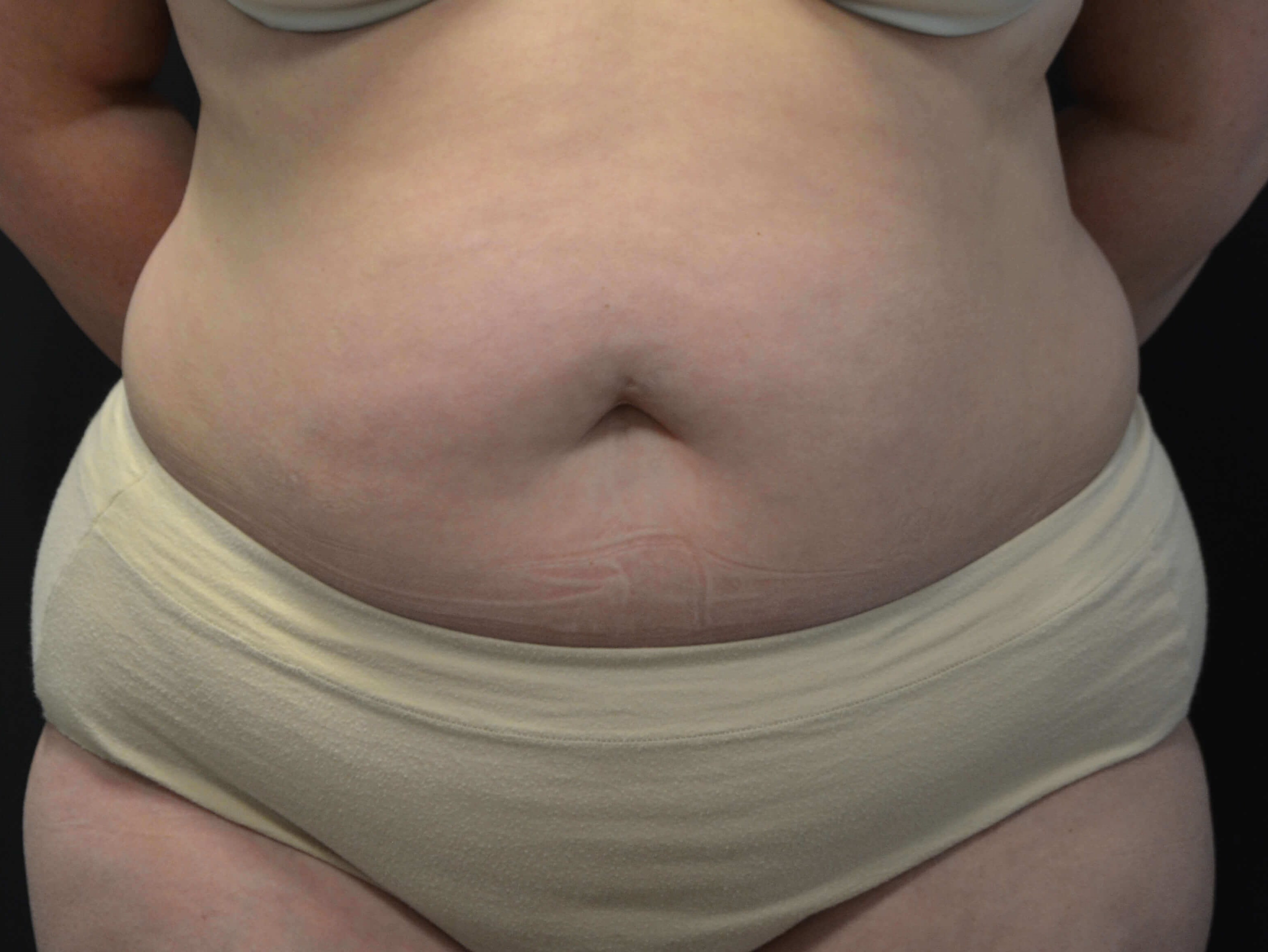 Tummy Tuck- Hinsdale, IL Before