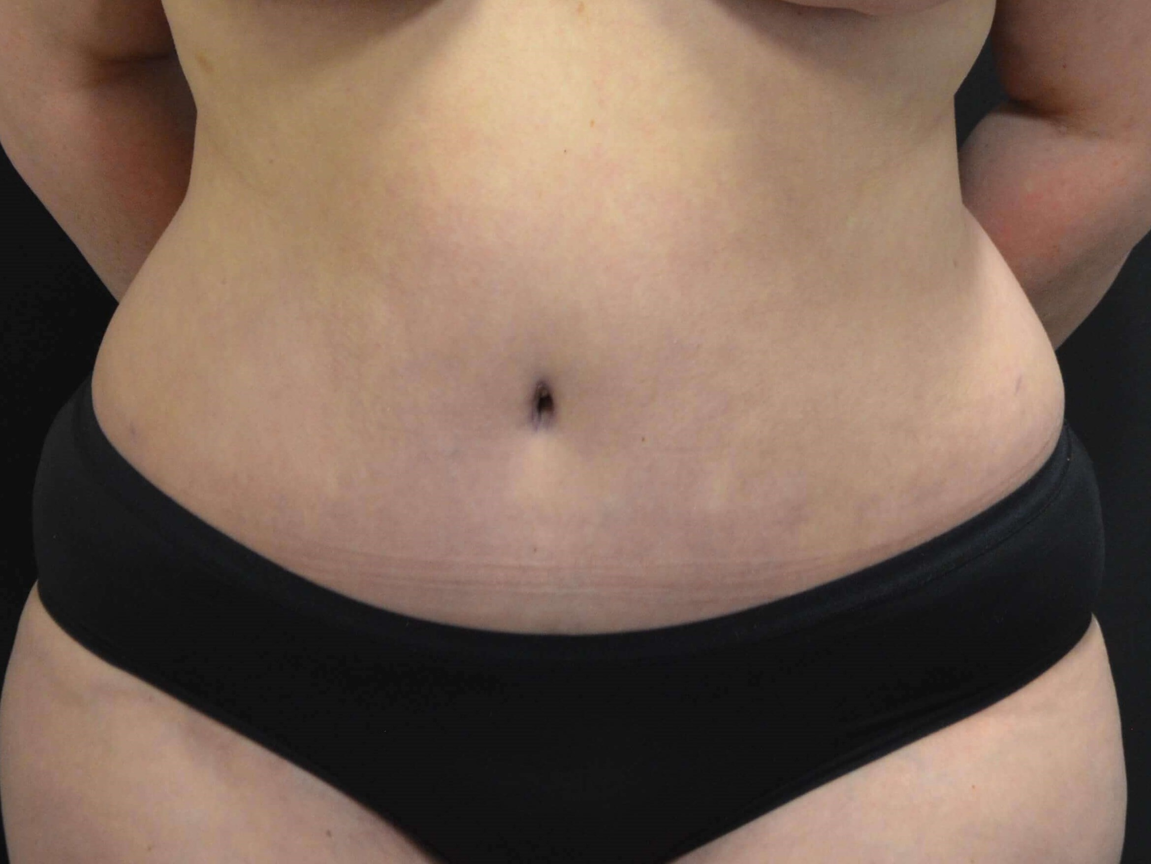 Tummy Tuck- Hinsdale, IL After