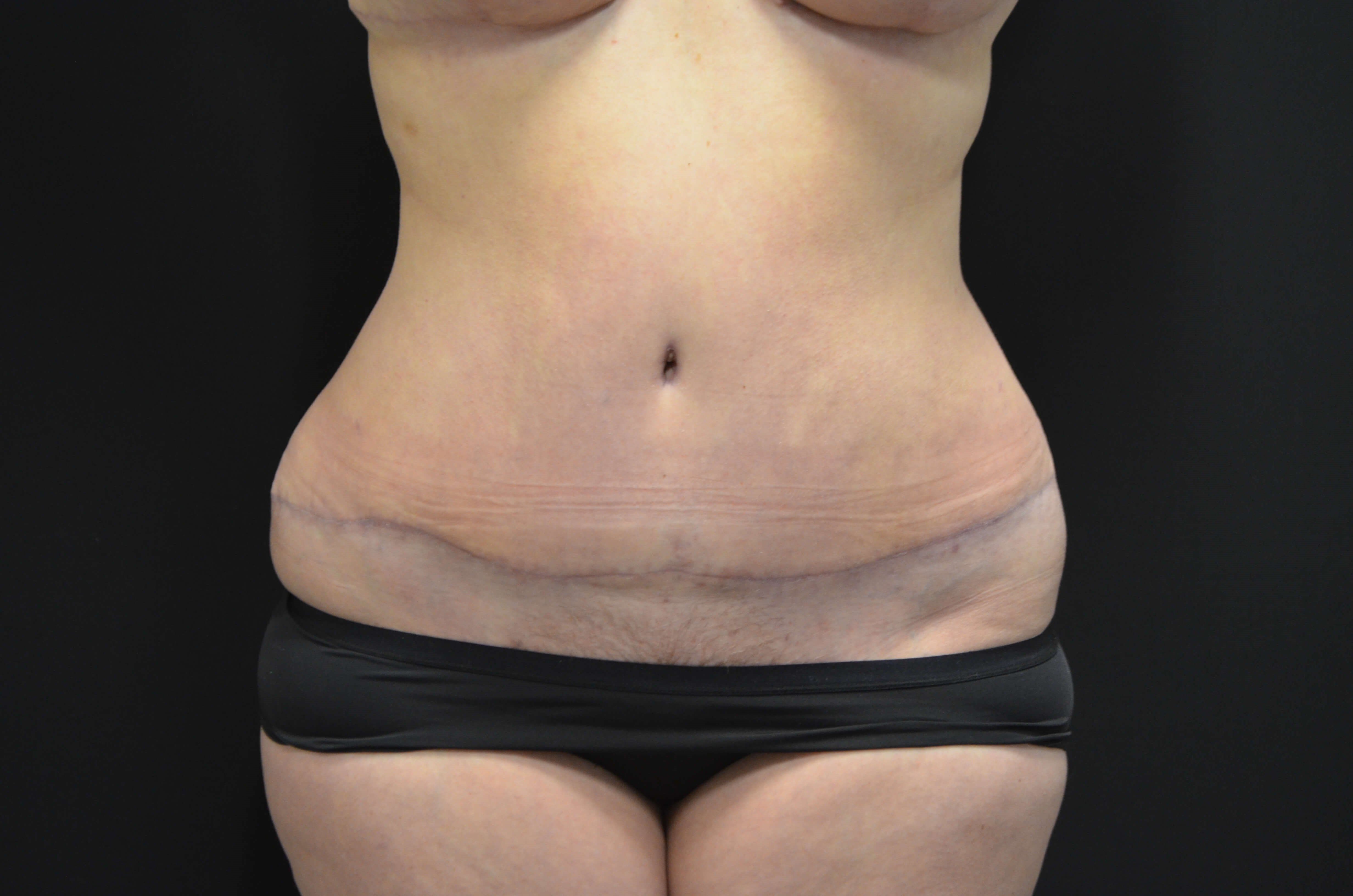 Tummy Tuck- Hinsdale, IL After