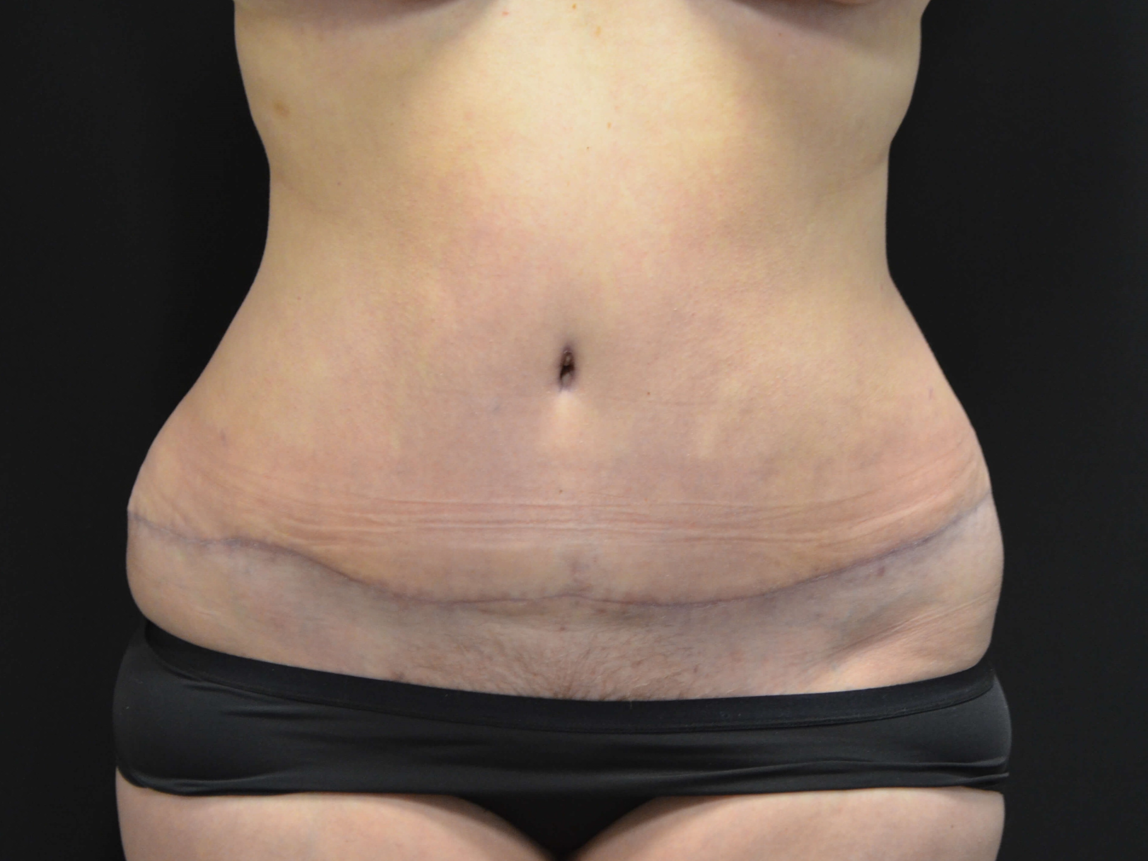 Tummy Tuck- Hinsdale, IL After