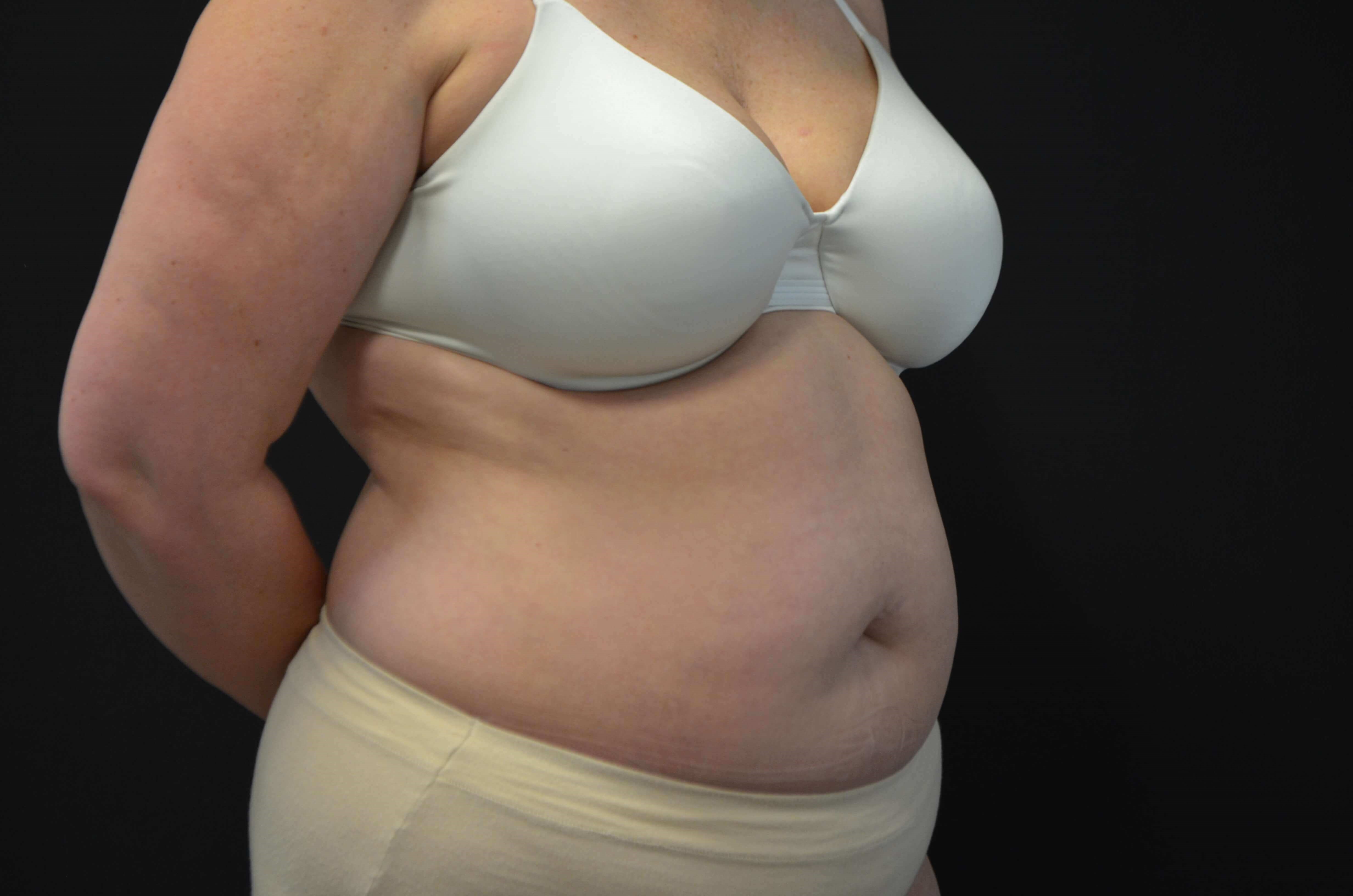 Tummy Tuck- Hinsdale, IL Before