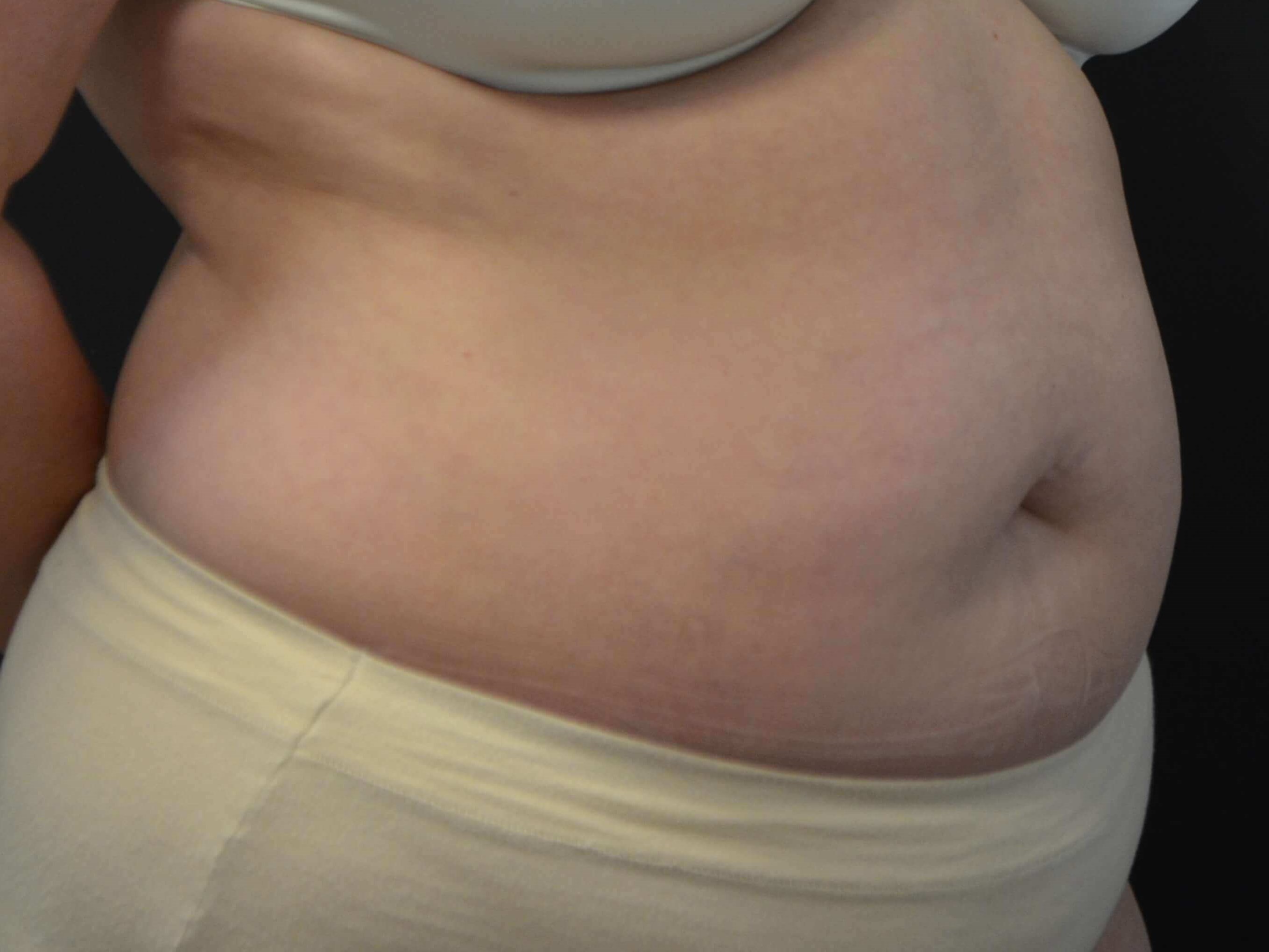 Tummy Tuck- Hinsdale, IL Before