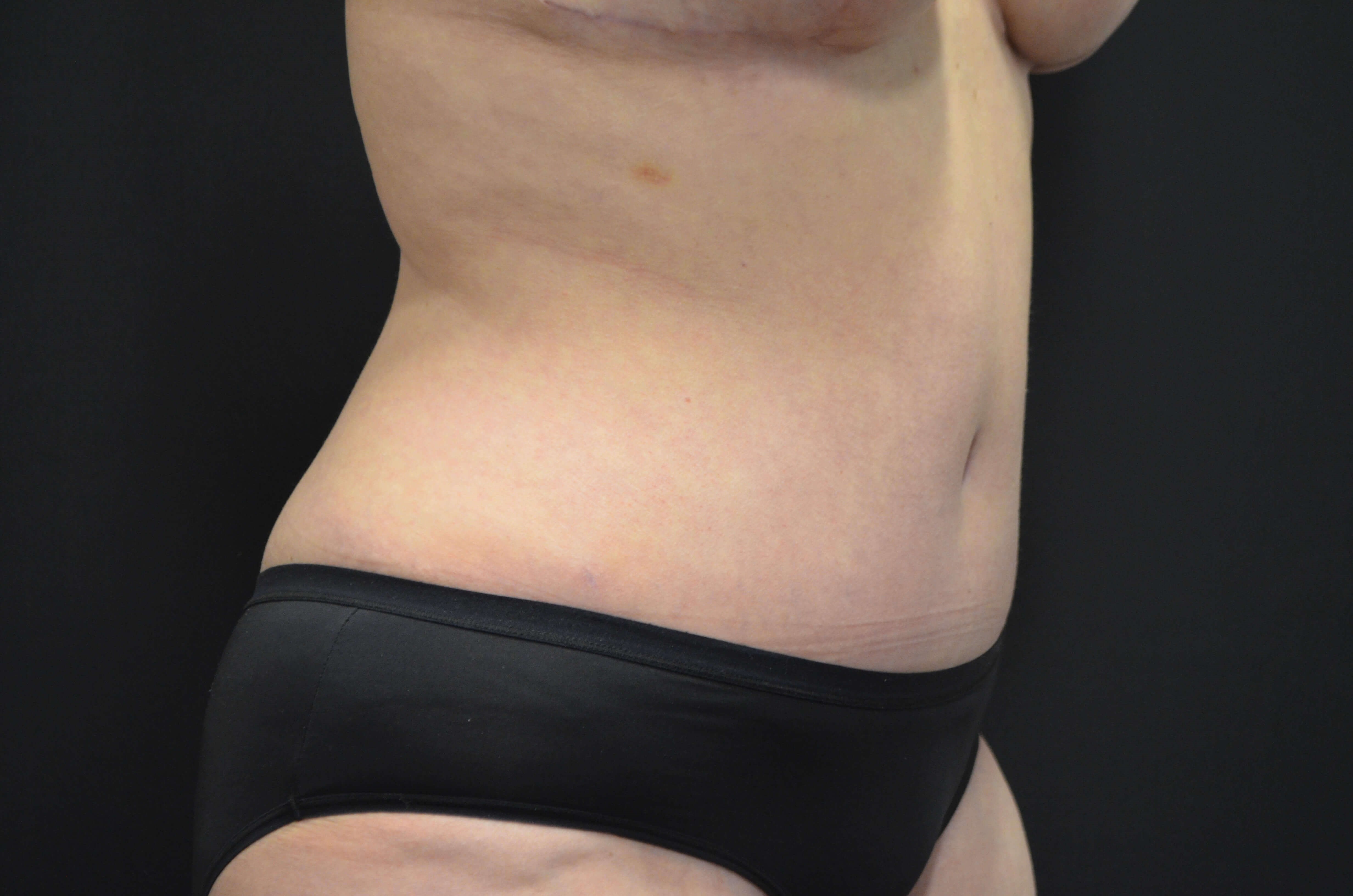 Tummy Tuck- Hinsdale, IL After