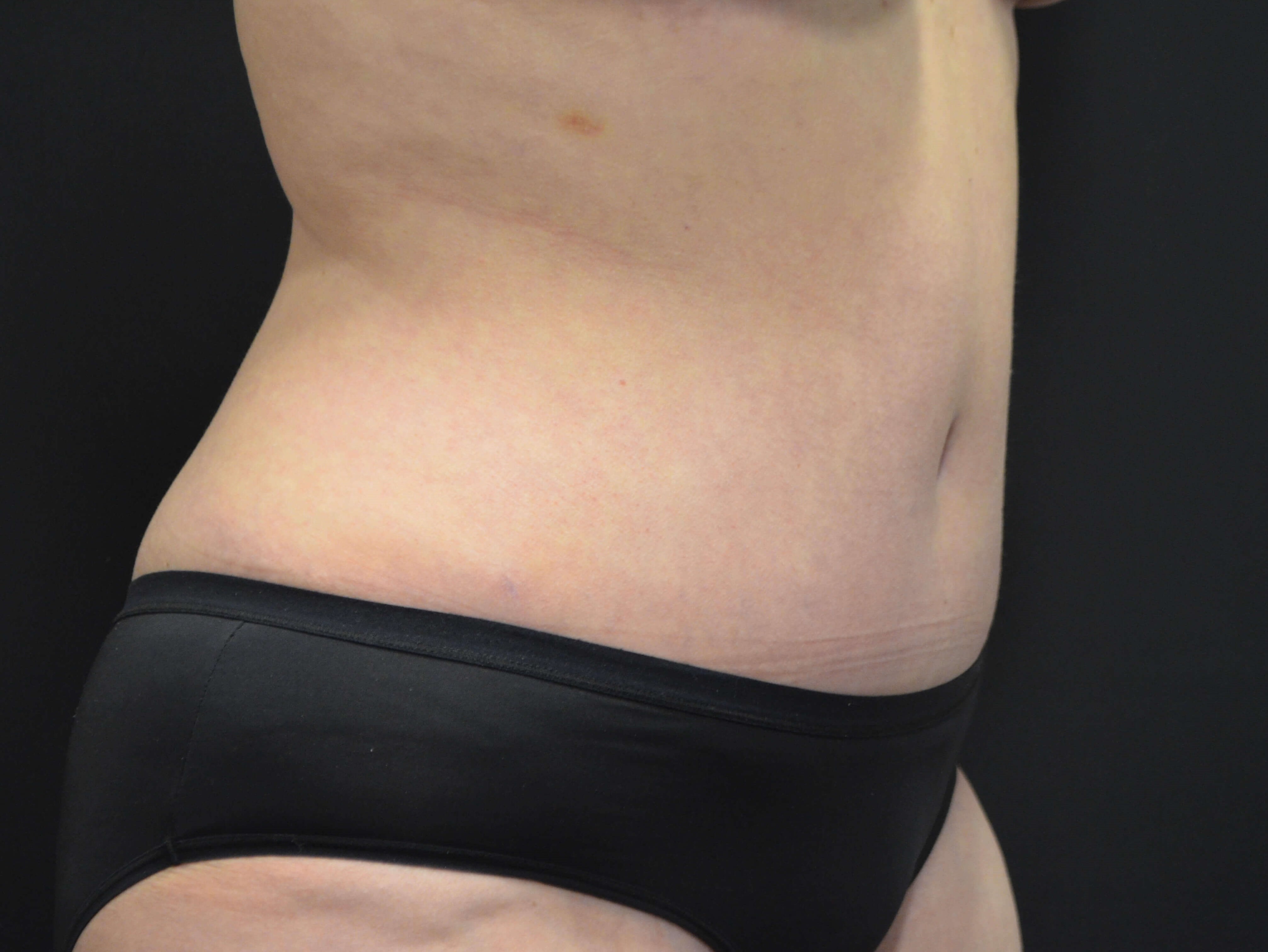 Tummy Tuck- Hinsdale, IL After