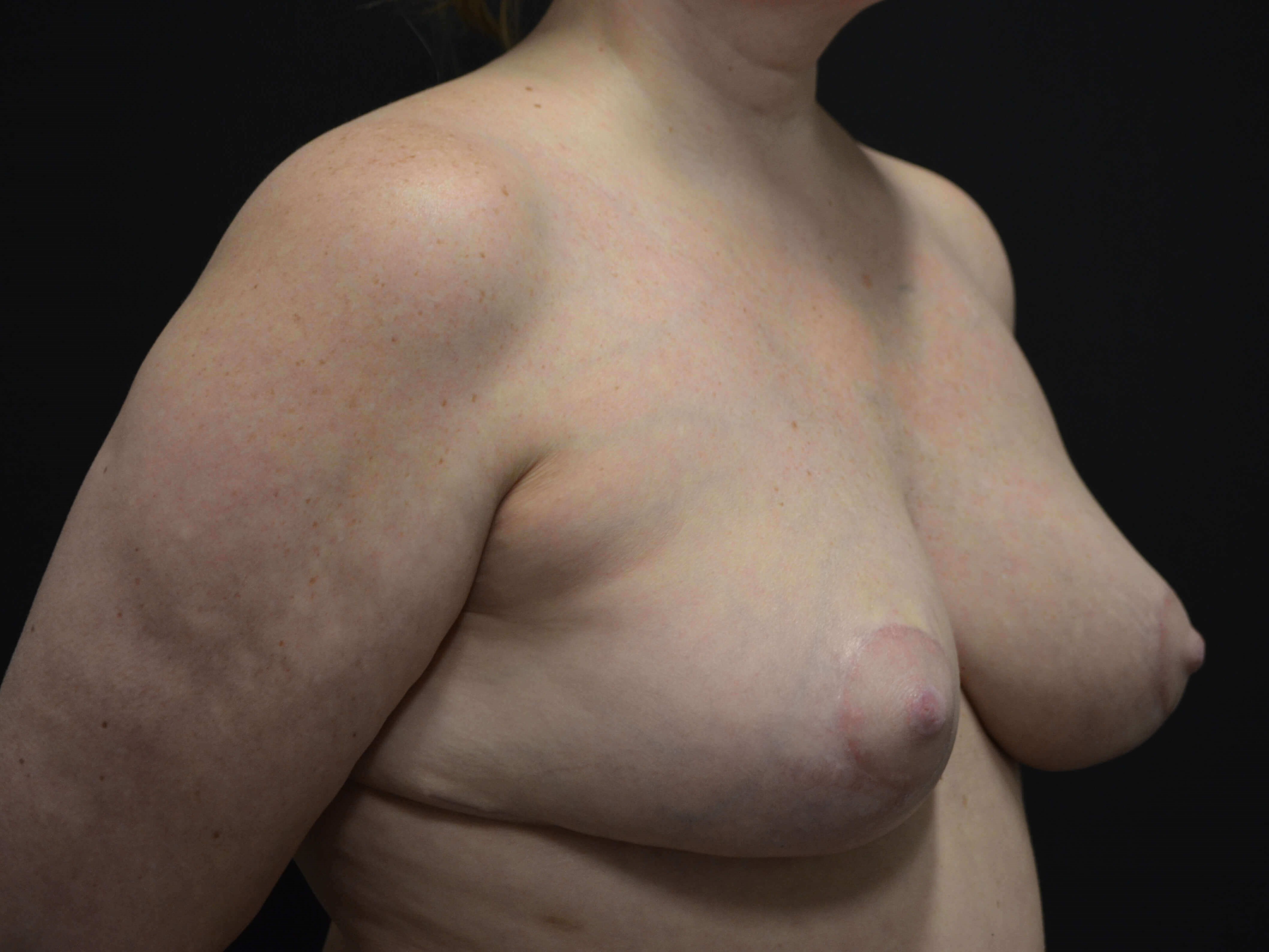Breast Lift- Hinsdale, IL After