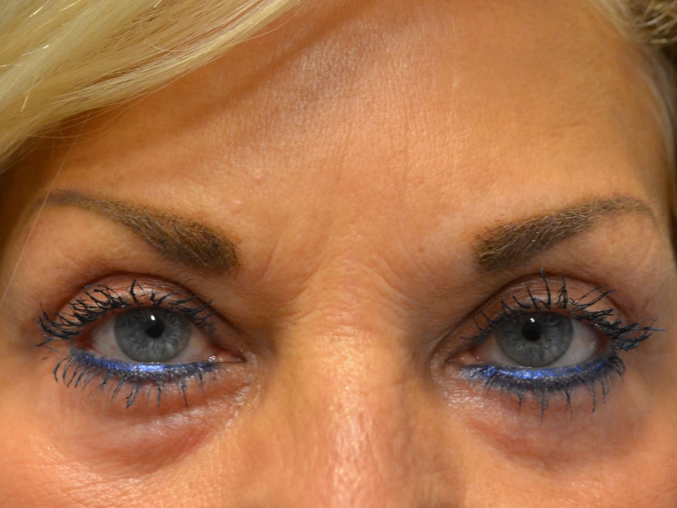 Upper Eyelid Lift After
