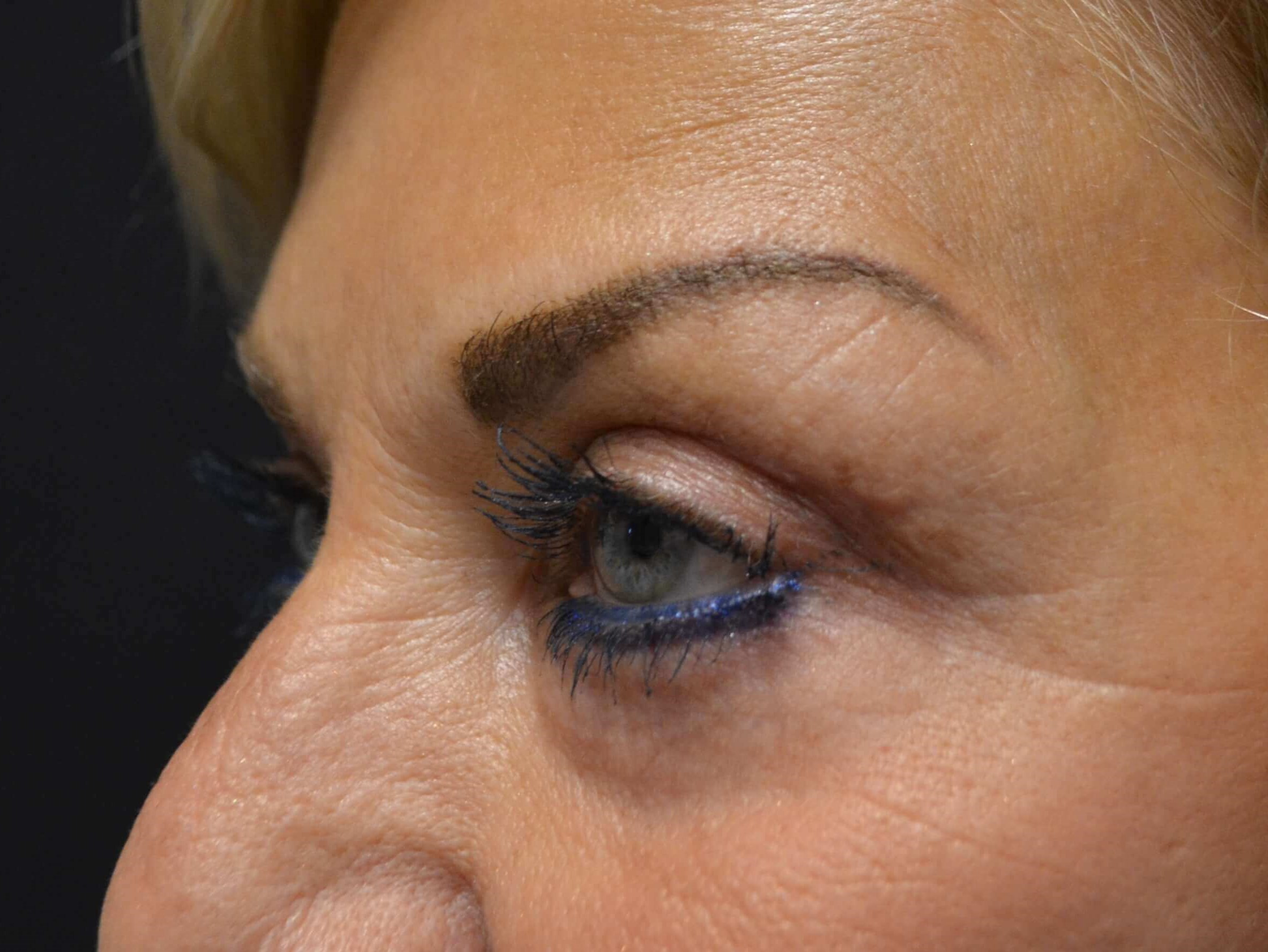 Upper Eyelid Lift After