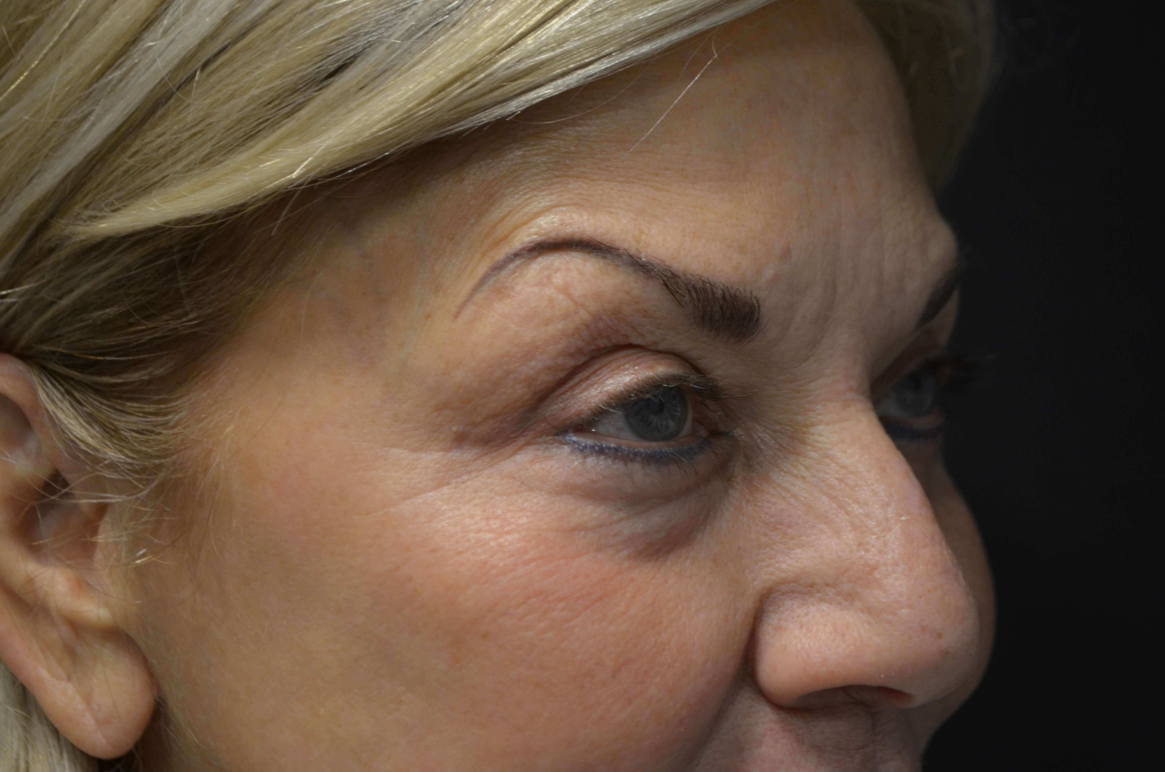 Upper Eyelid Lift Before