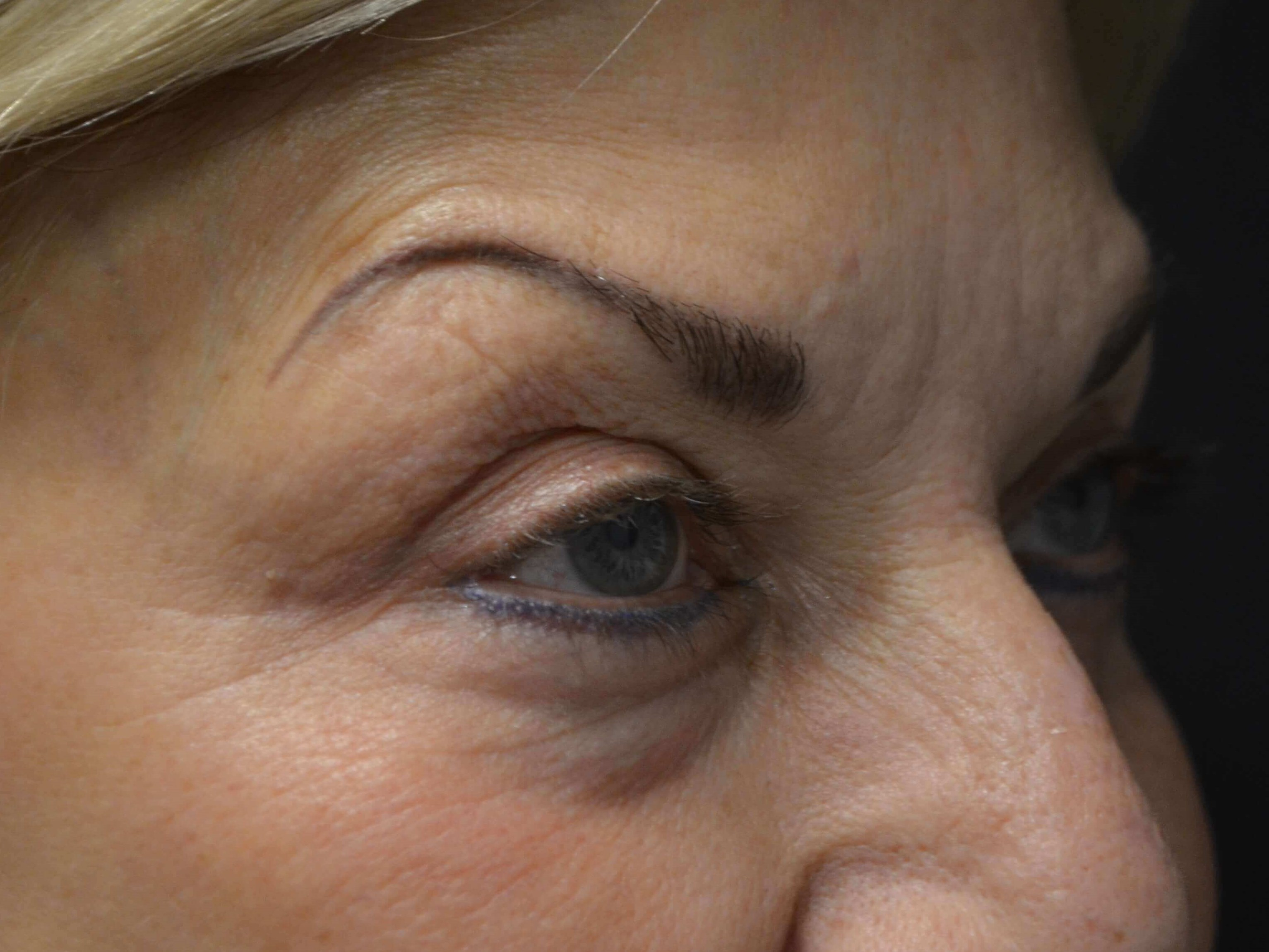 Upper Eyelid Lift Before