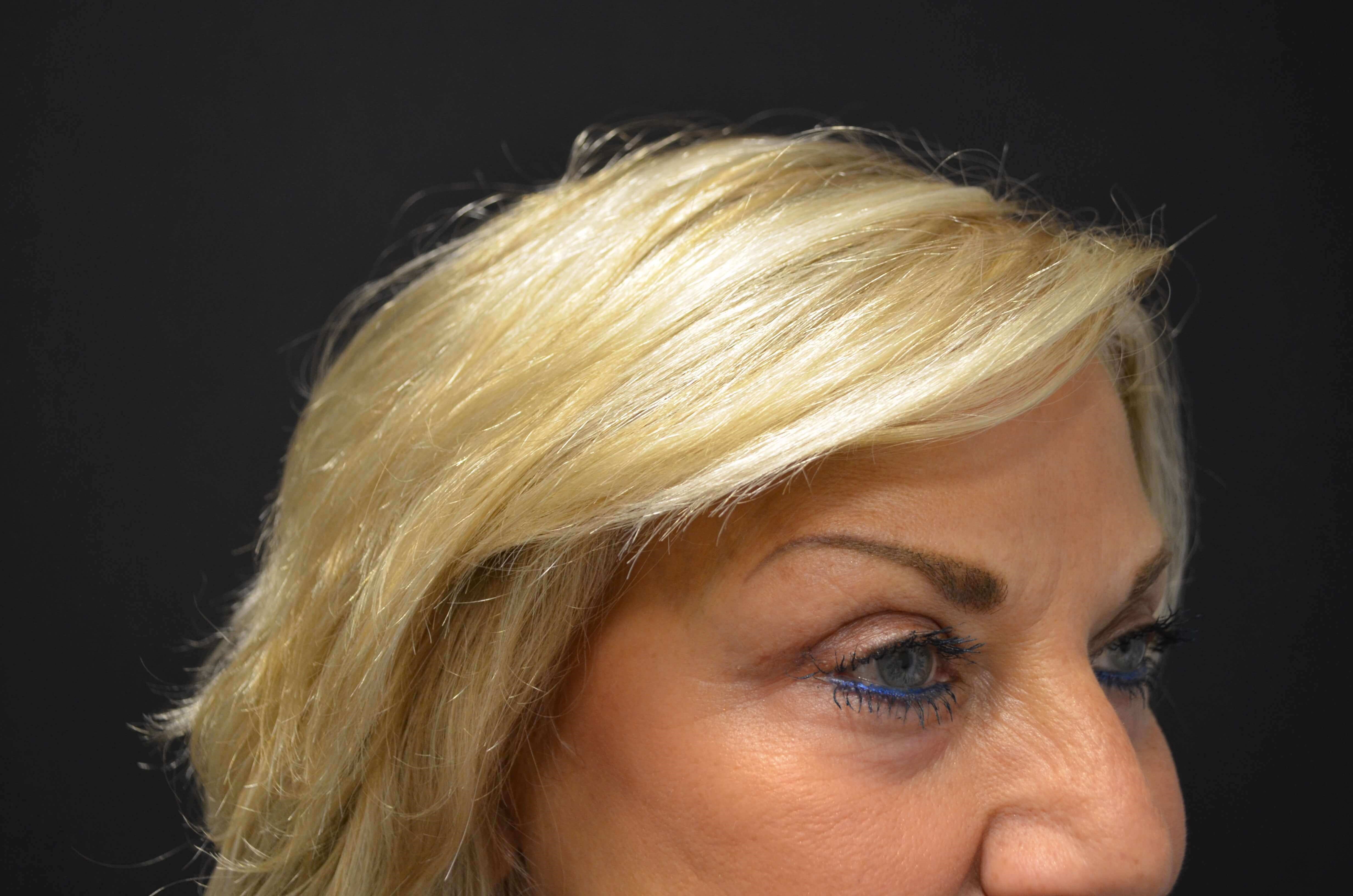 Upper Eyelid Lift After