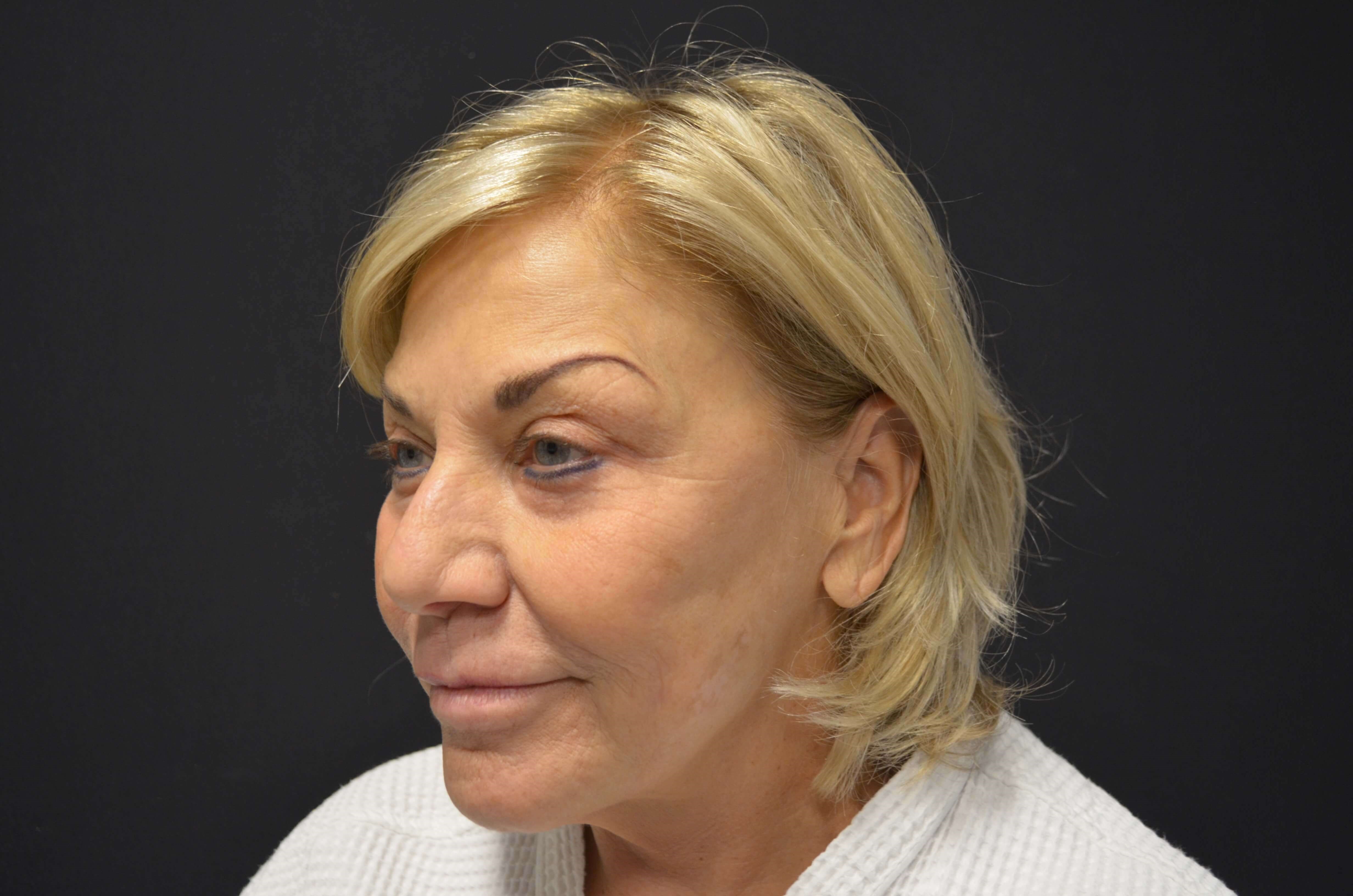 Upper Eyelid Lift Before