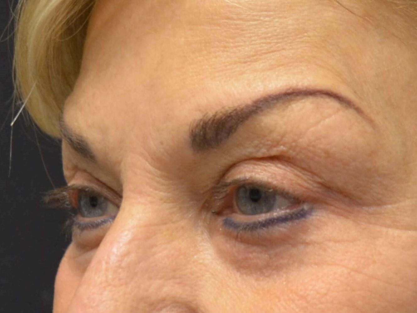 Upper Eyelid Lift Before