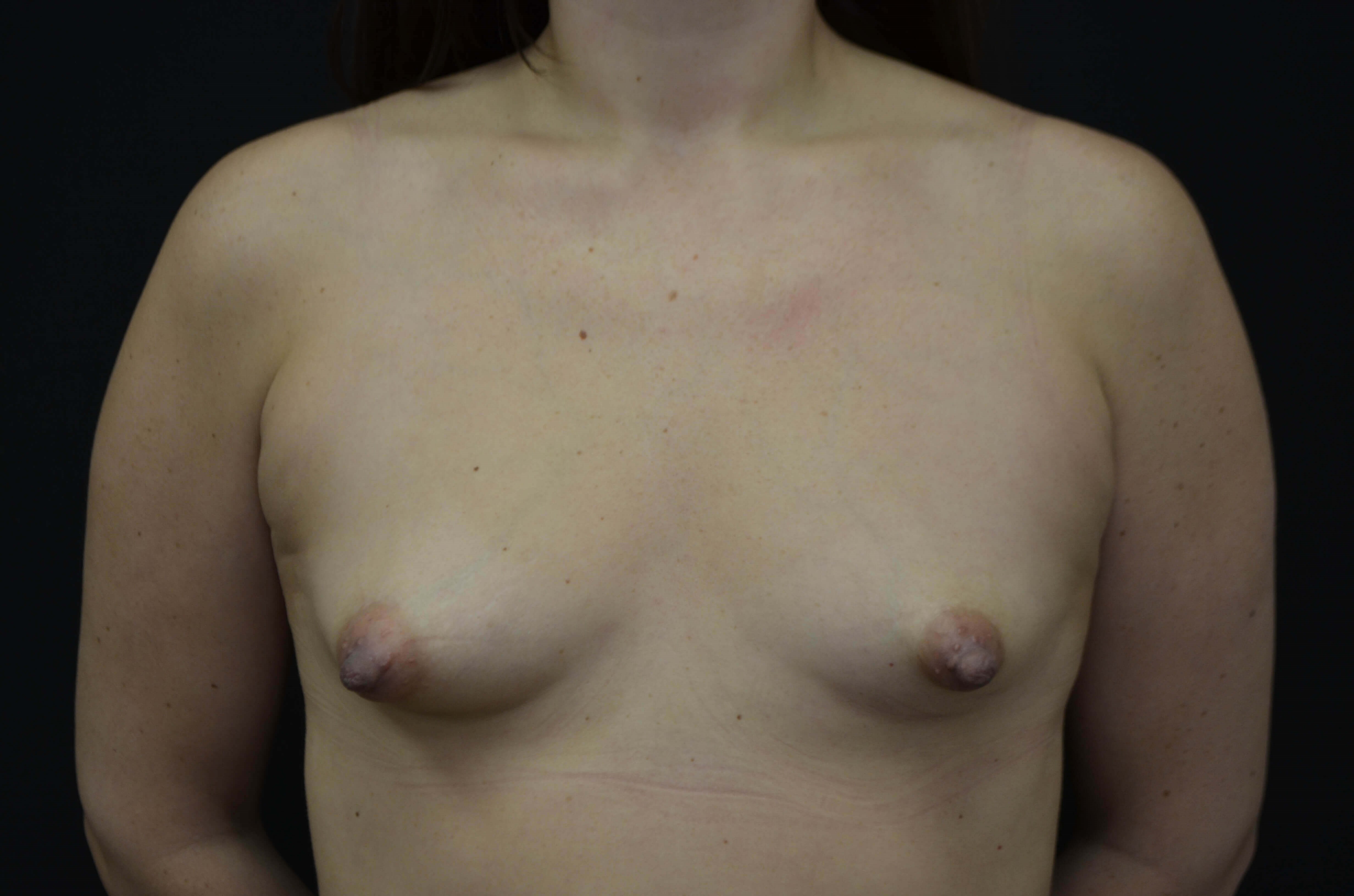 Breast Augmentation Before