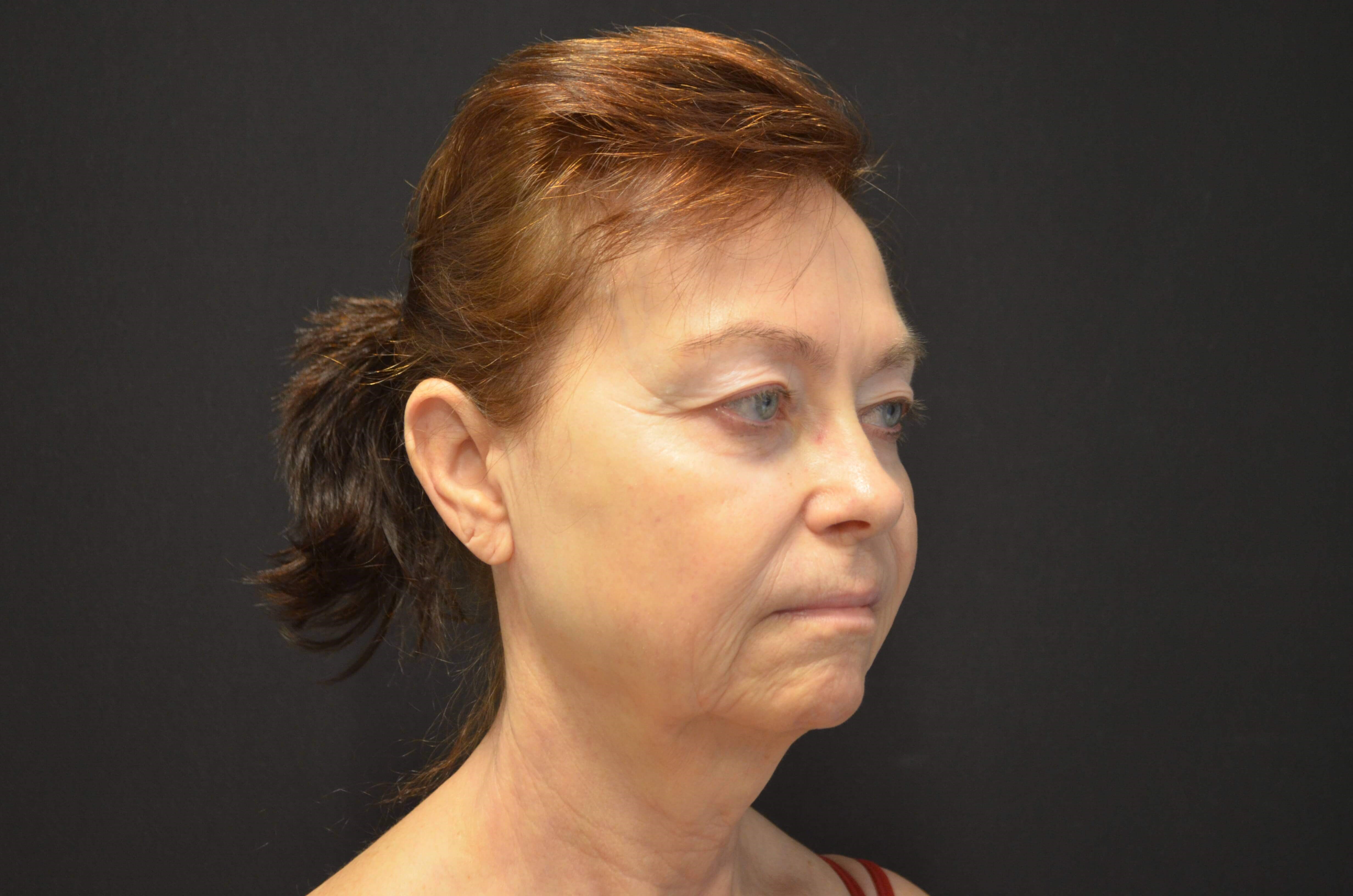 Natural Lower Face & Neck Lift Before