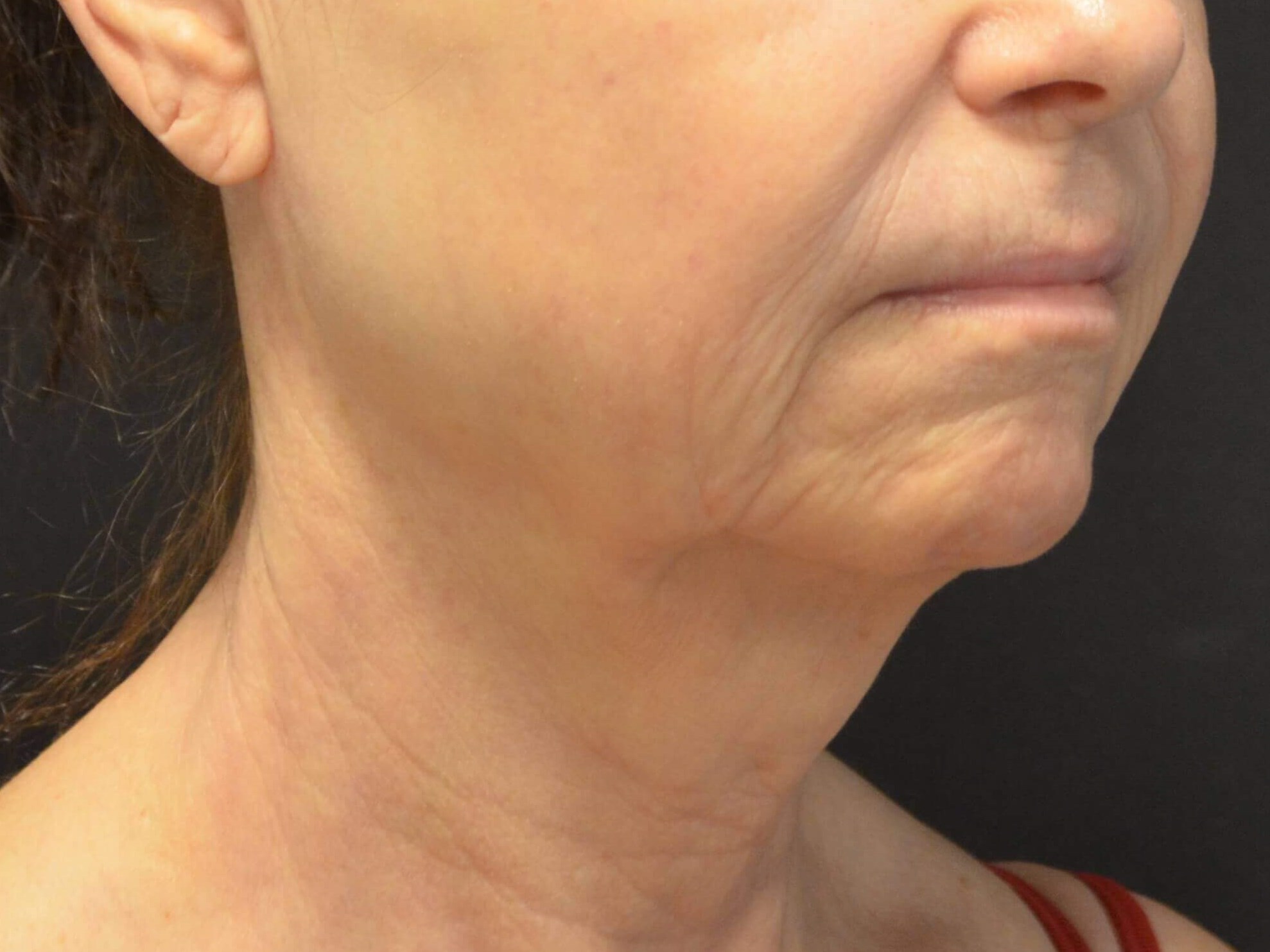 Natural Lower Face & Neck Lift Before