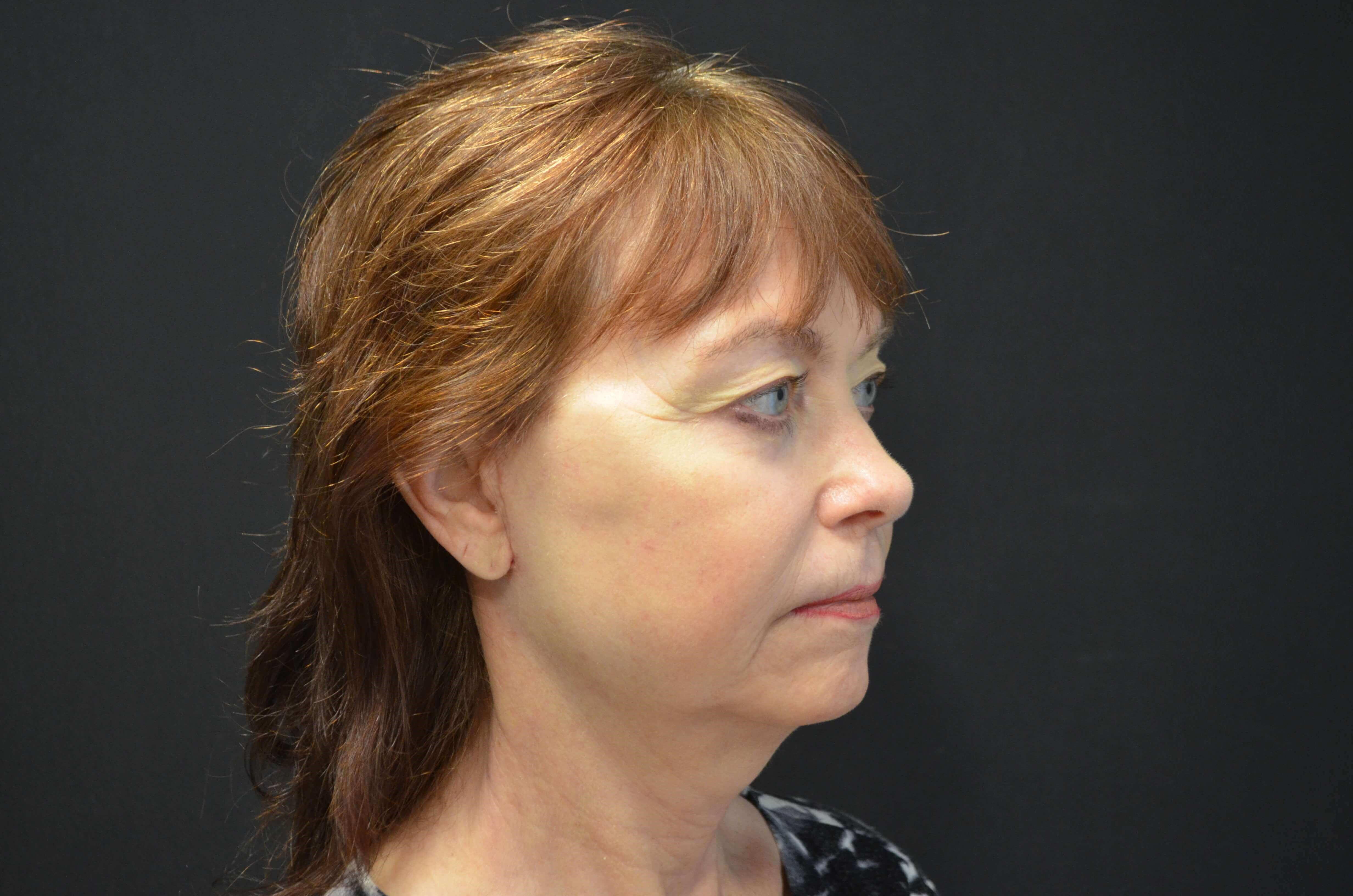 Natural Lower Face & Neck Lift After