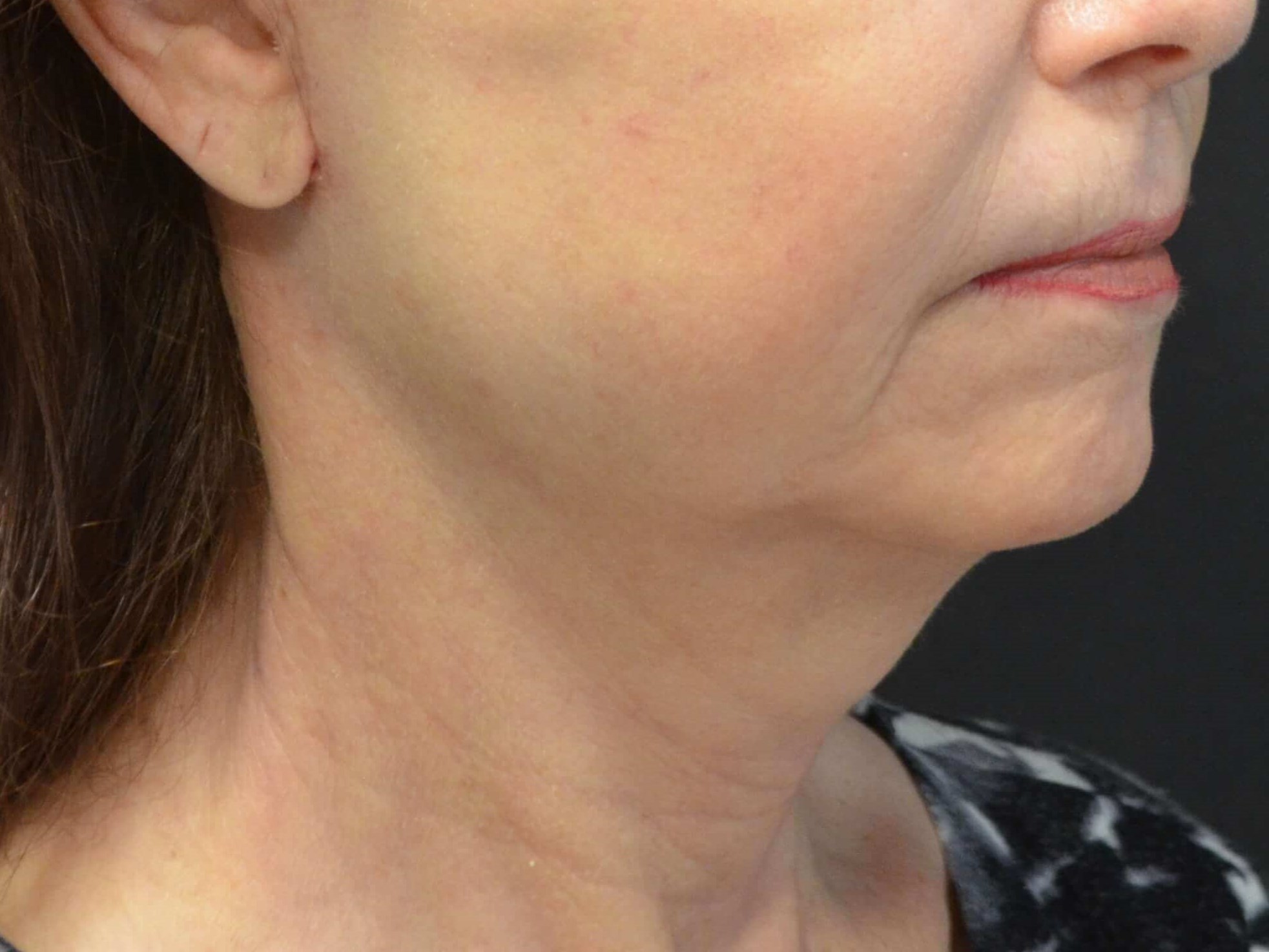 Natural Lower Face & Neck Lift After
