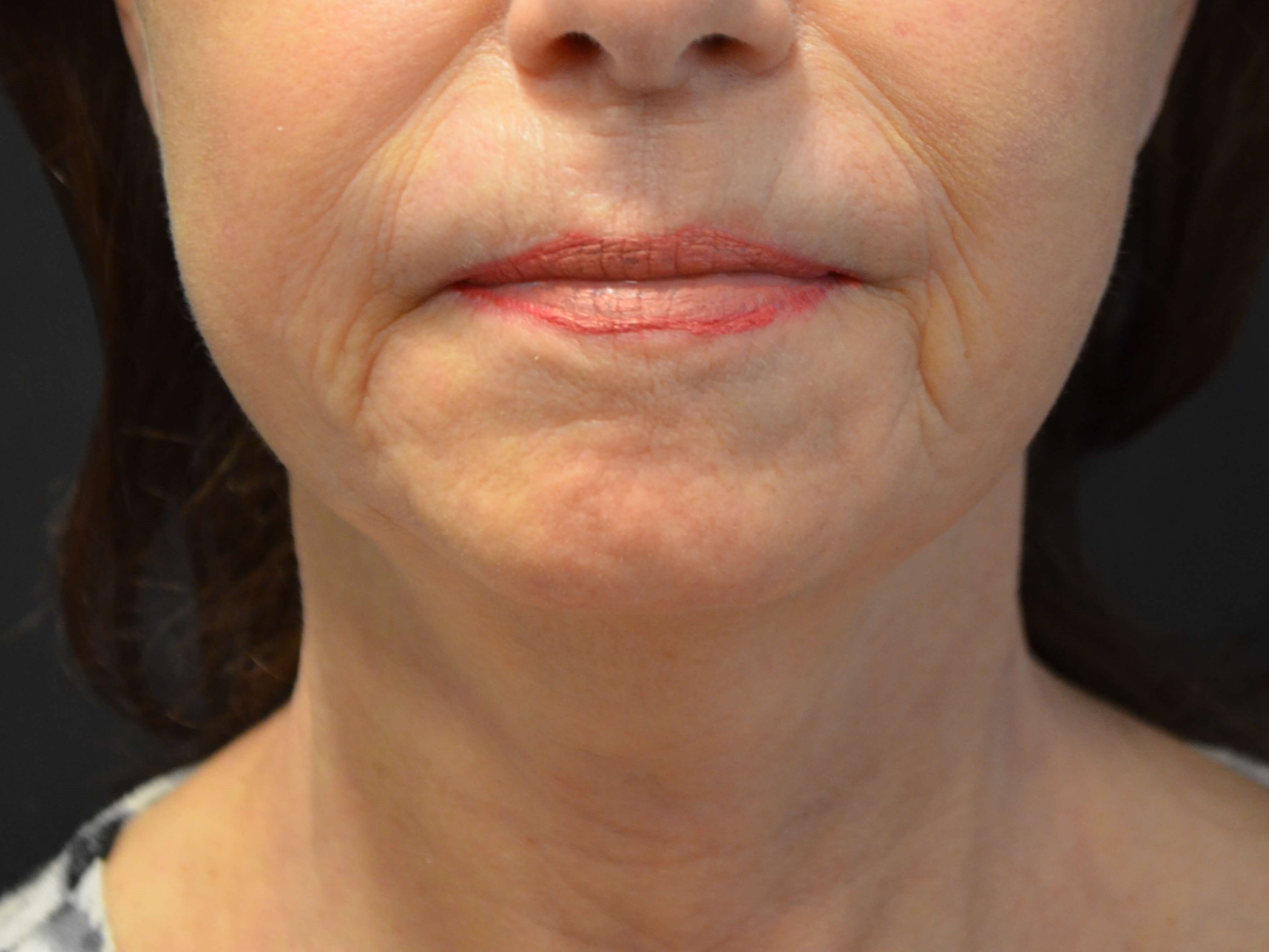 Natural Lower Face & Neck Lift After