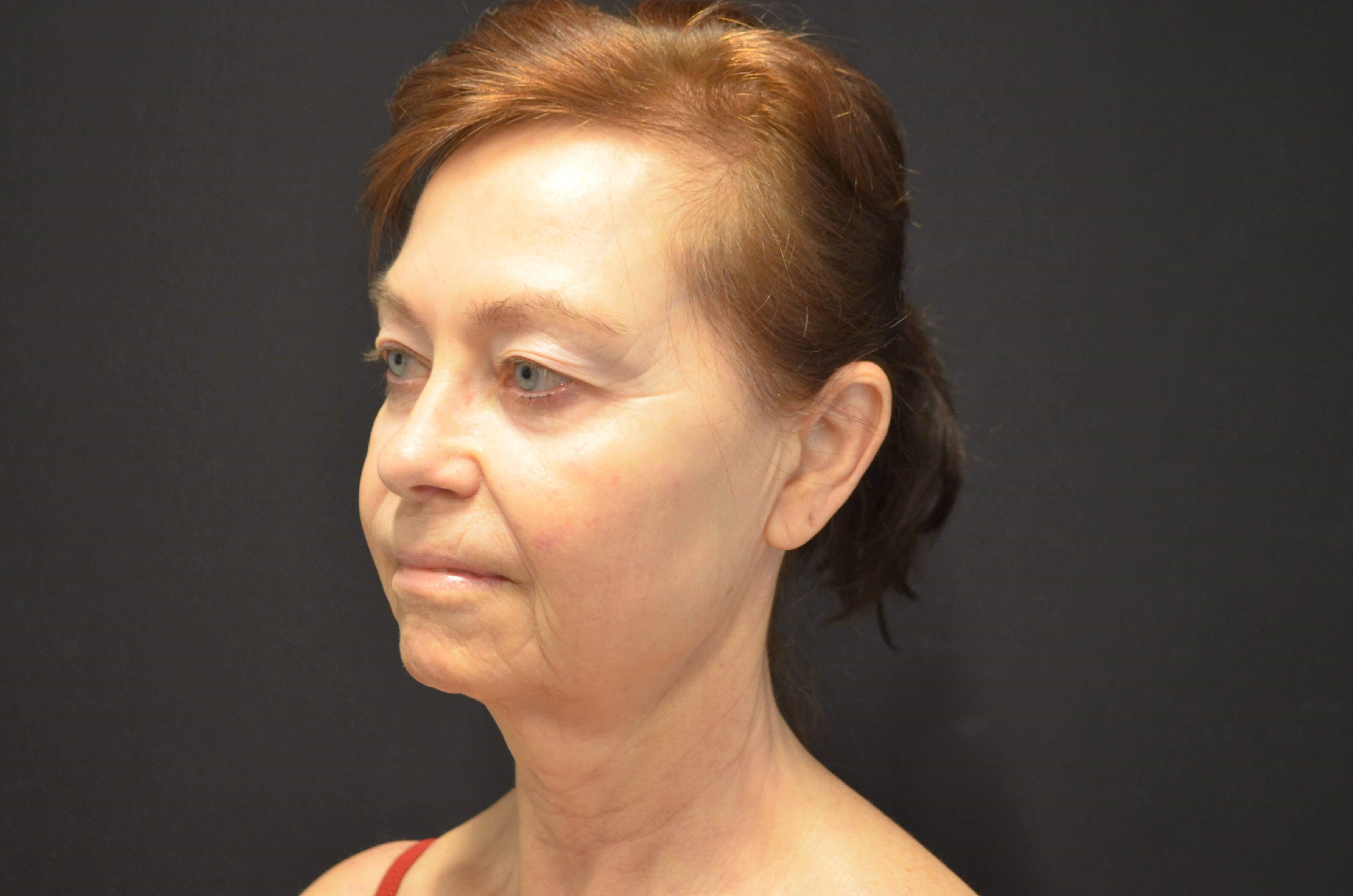 Natural Lower Face & Neck Lift Before
