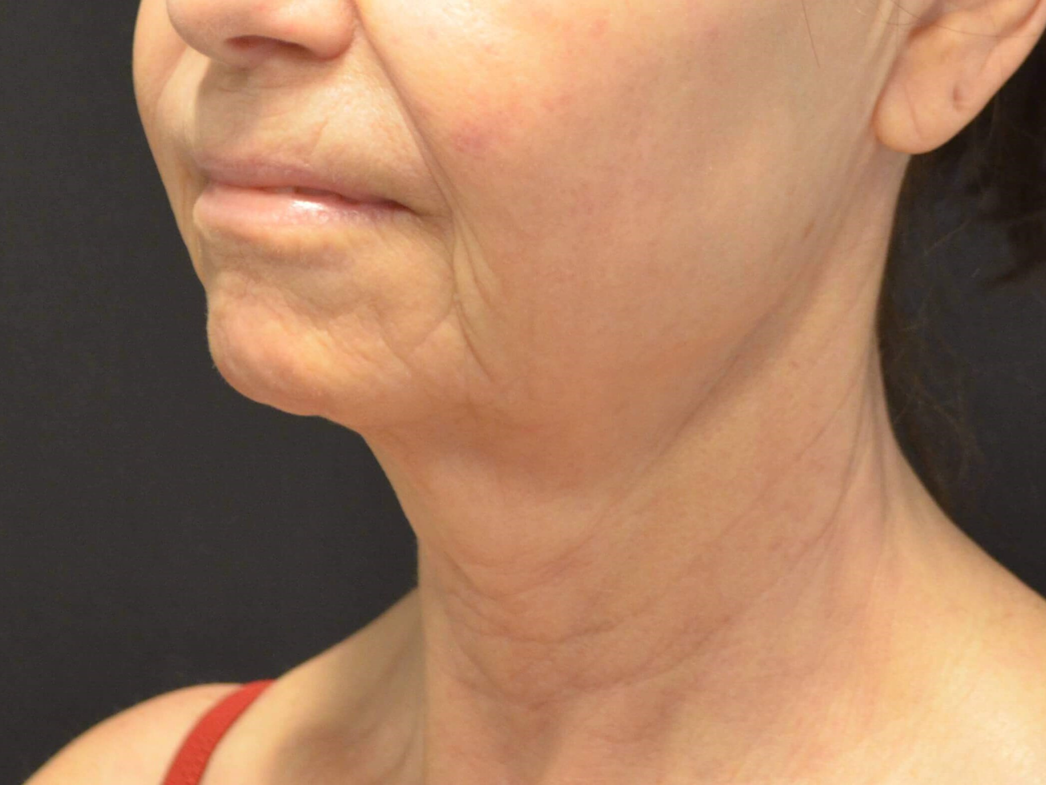 Natural Lower Face & Neck Lift Before