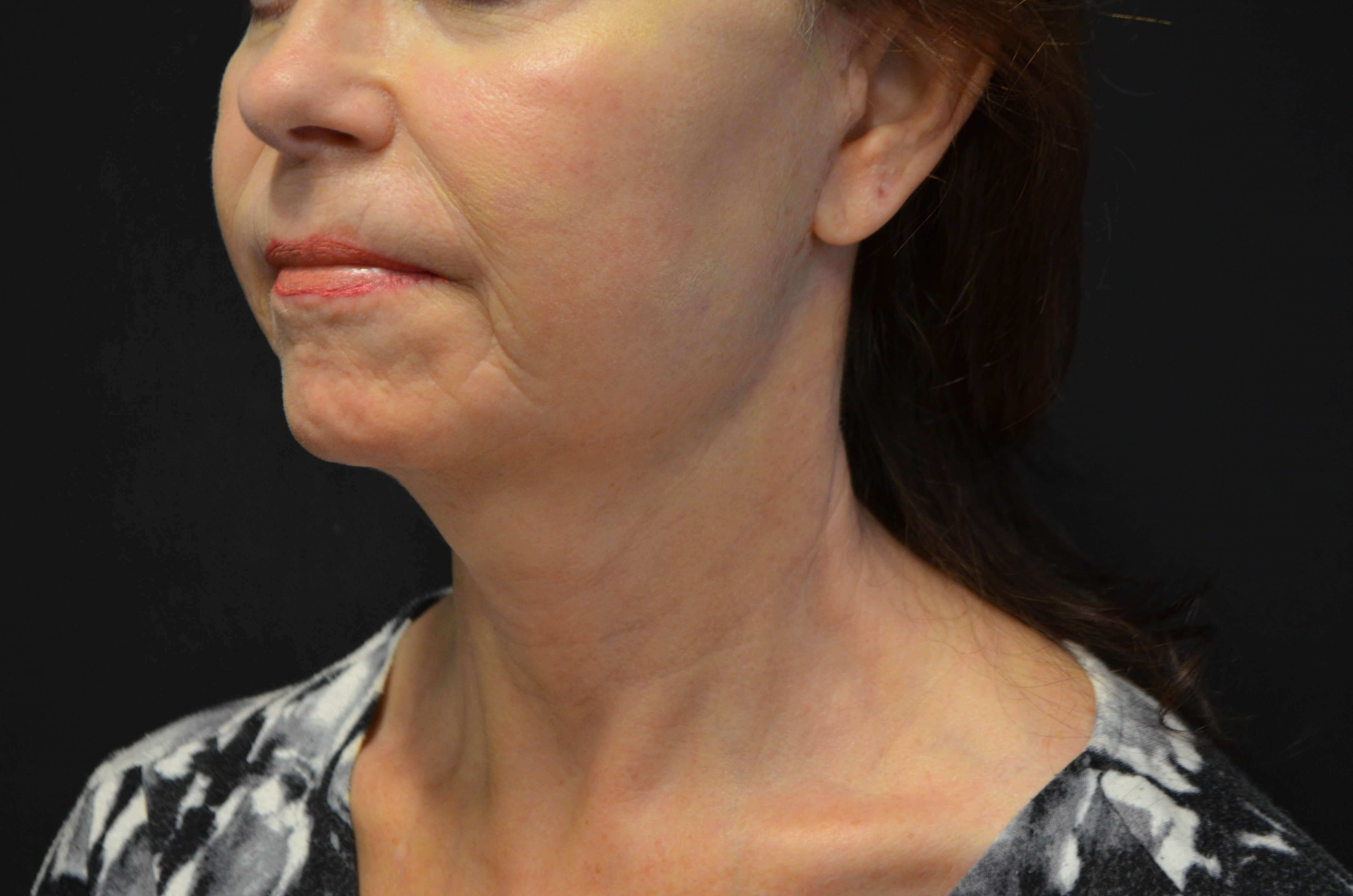 Natural Lower Face & Neck Lift After