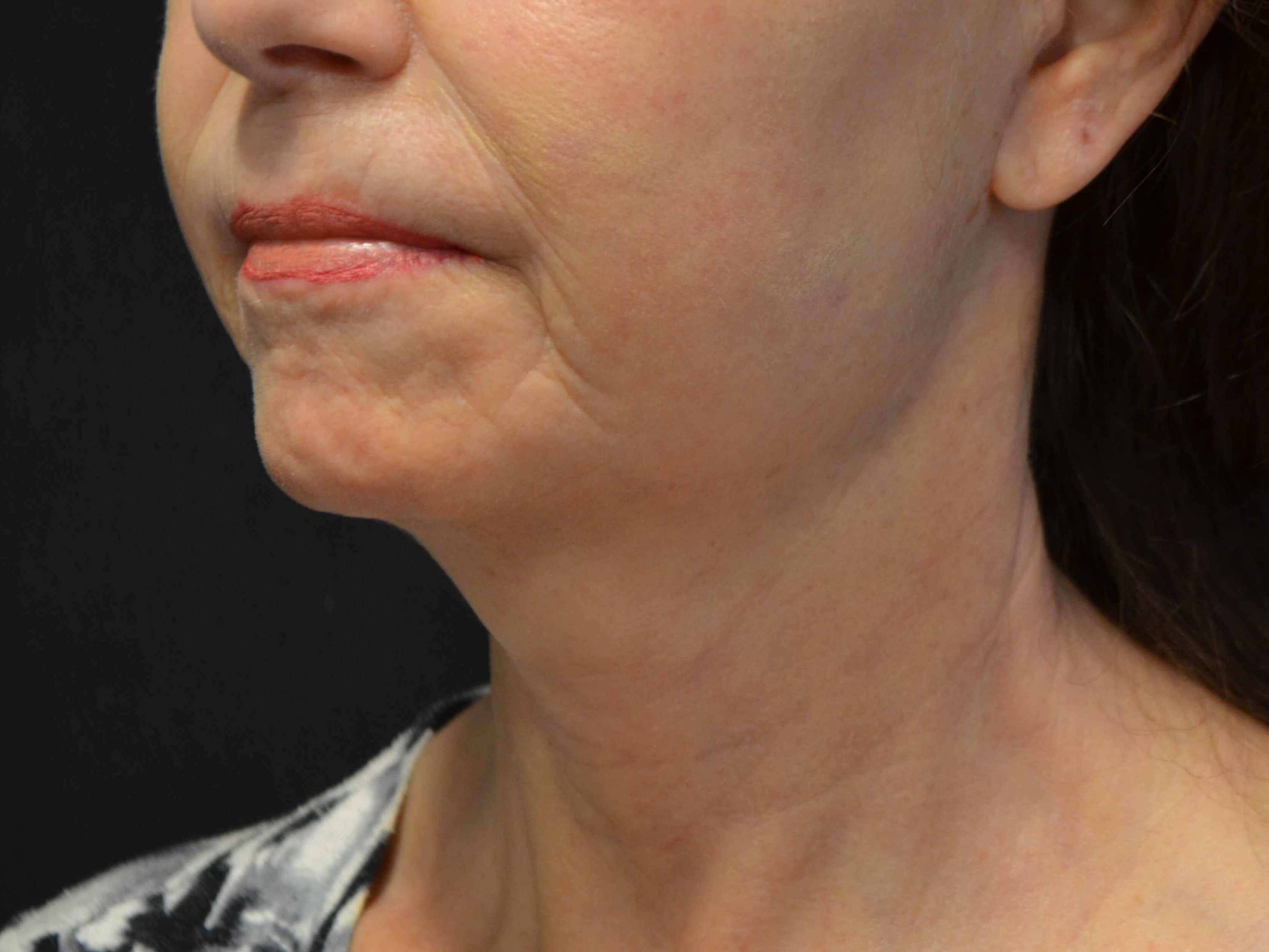 Natural Lower Face & Neck Lift After